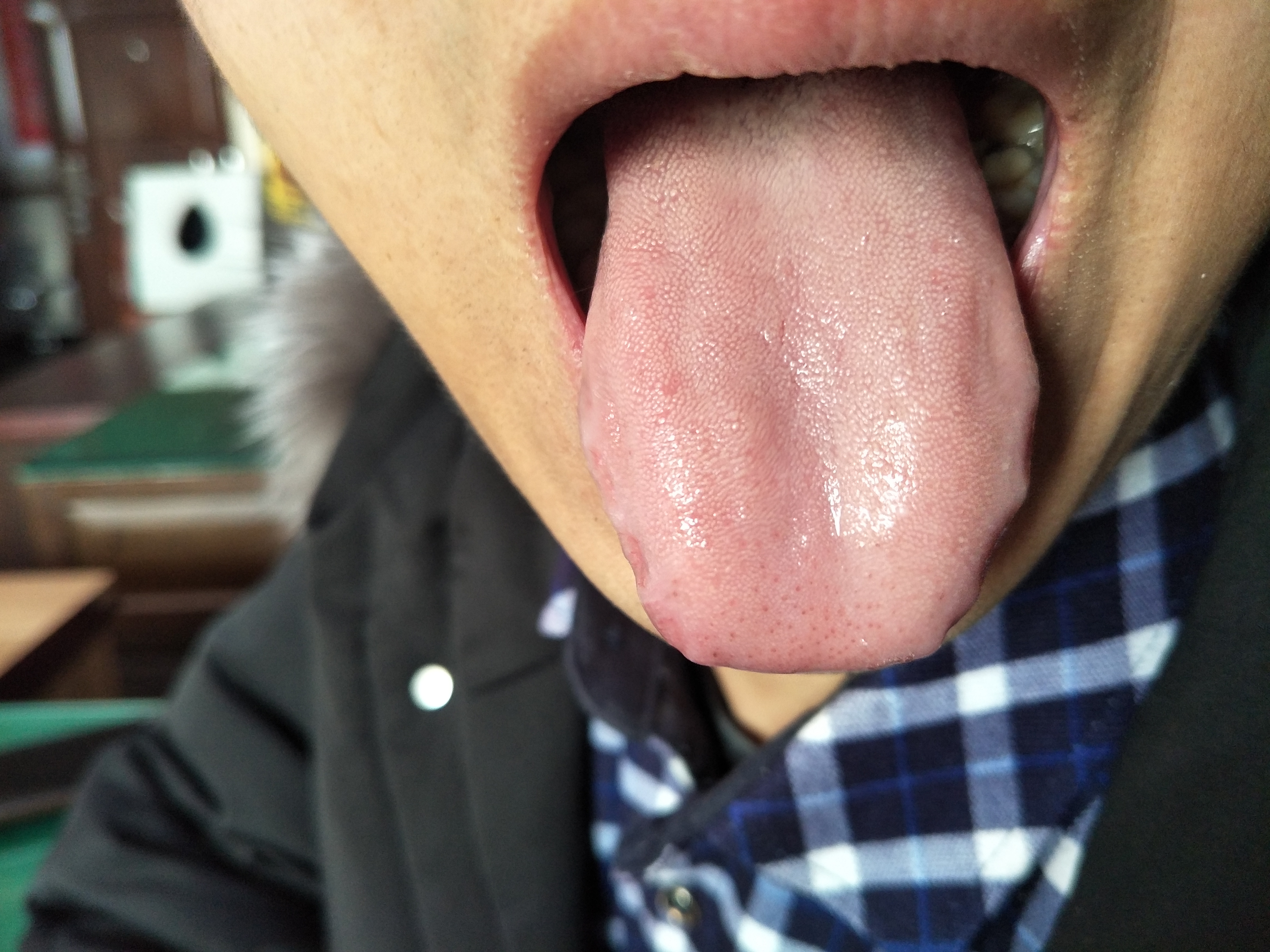 男，35岁，间断心慌，乏力近半年 舌面.jpg