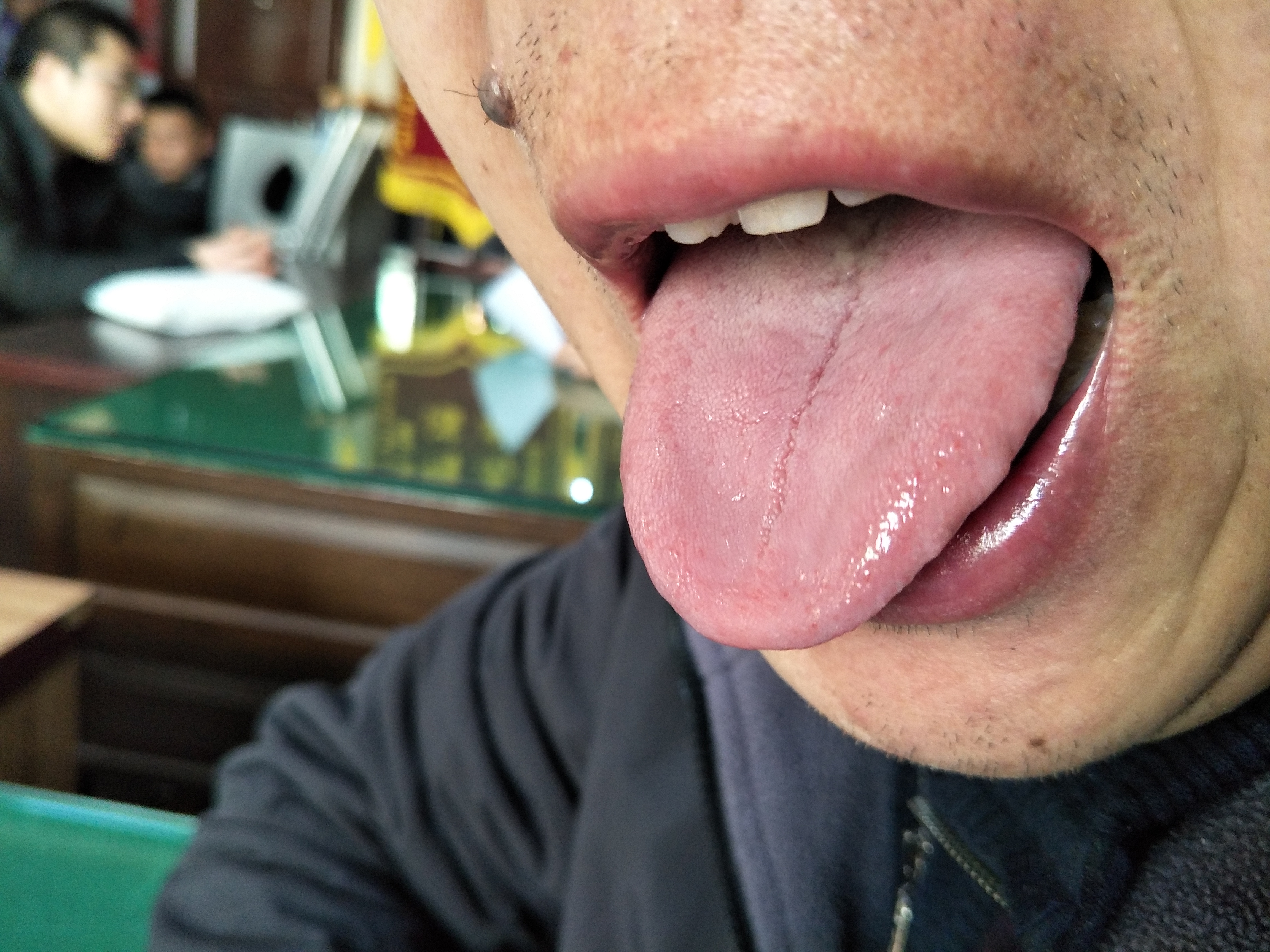 男，39岁，发现感染乙肝病毒13年余  舌下.jpg