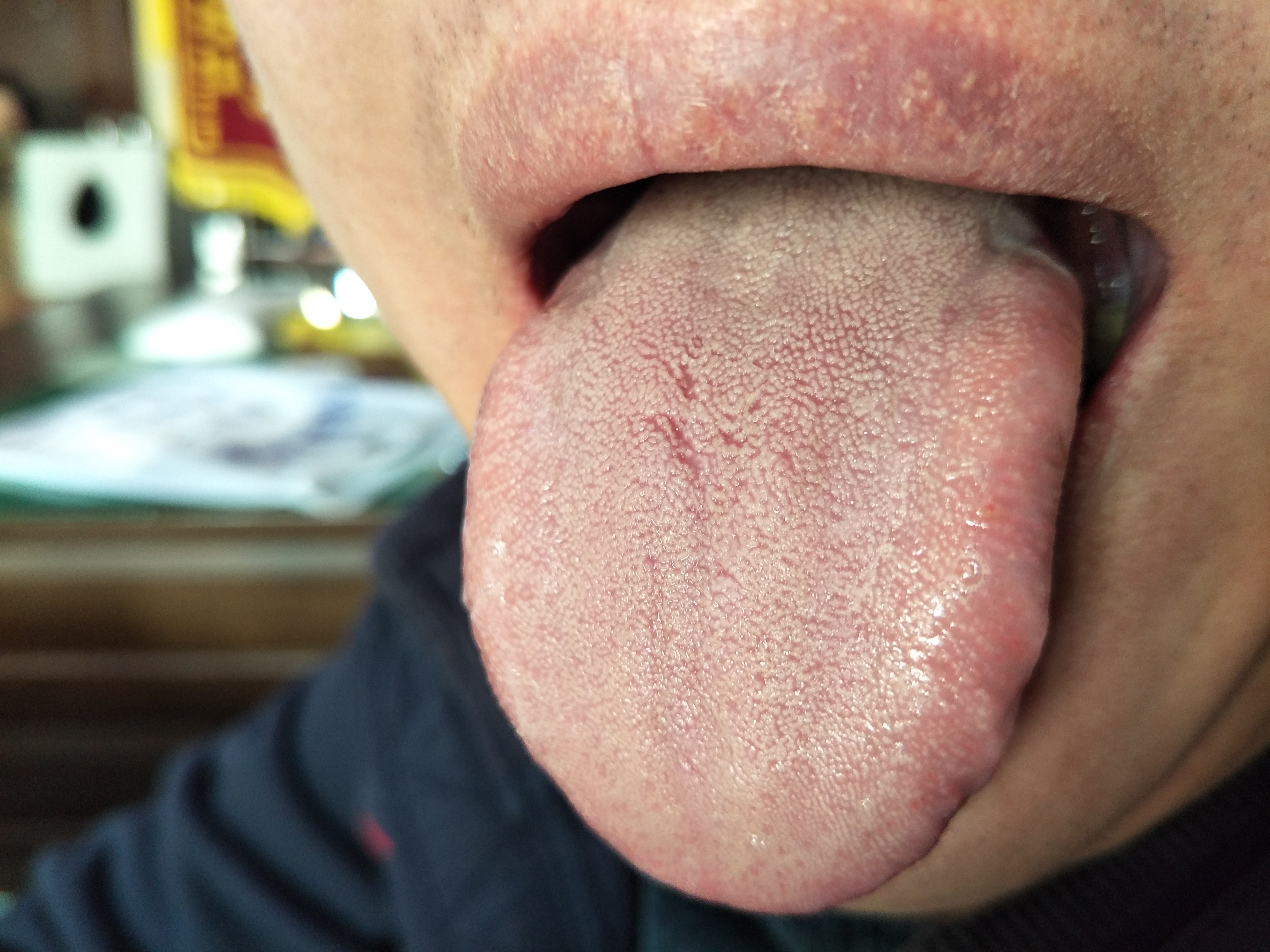 男，42岁，耳鸣4年，左手震颤10余年 舌面.jpg