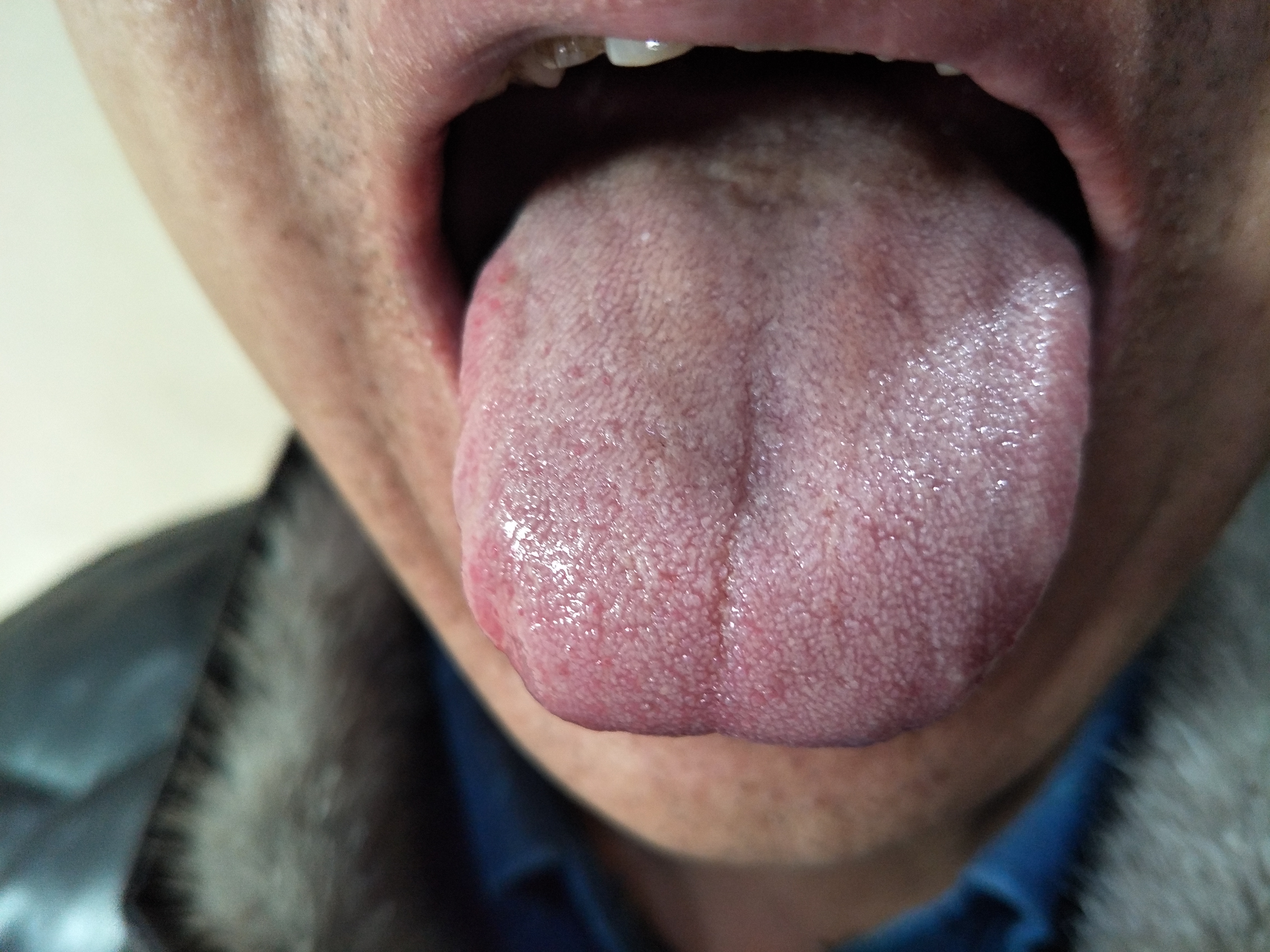 男，47岁，性欲减退，早泄2年余 舌面.jpg