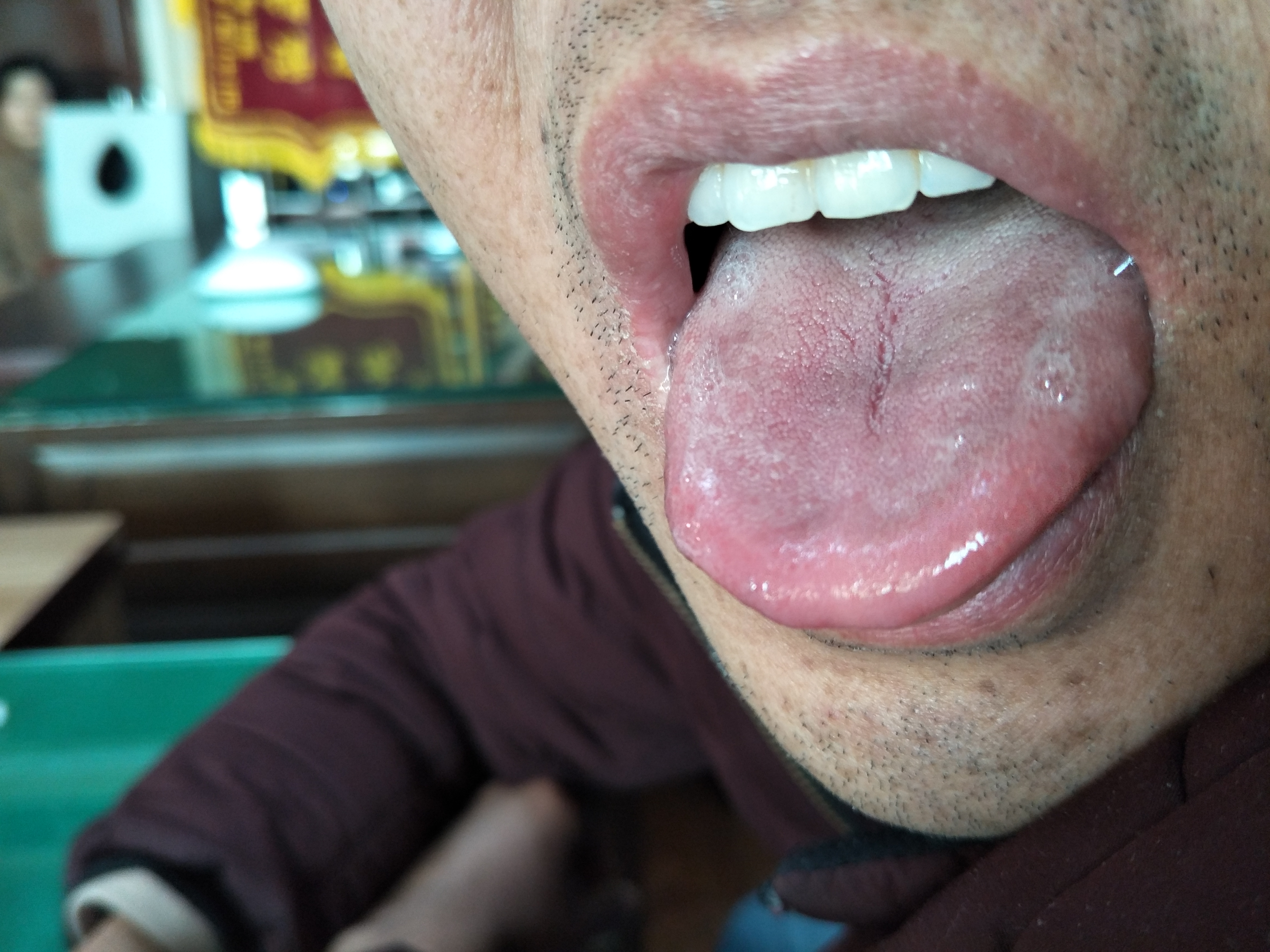 男，48岁，双侧腹股沟胀痛1年余 舌面.jpg