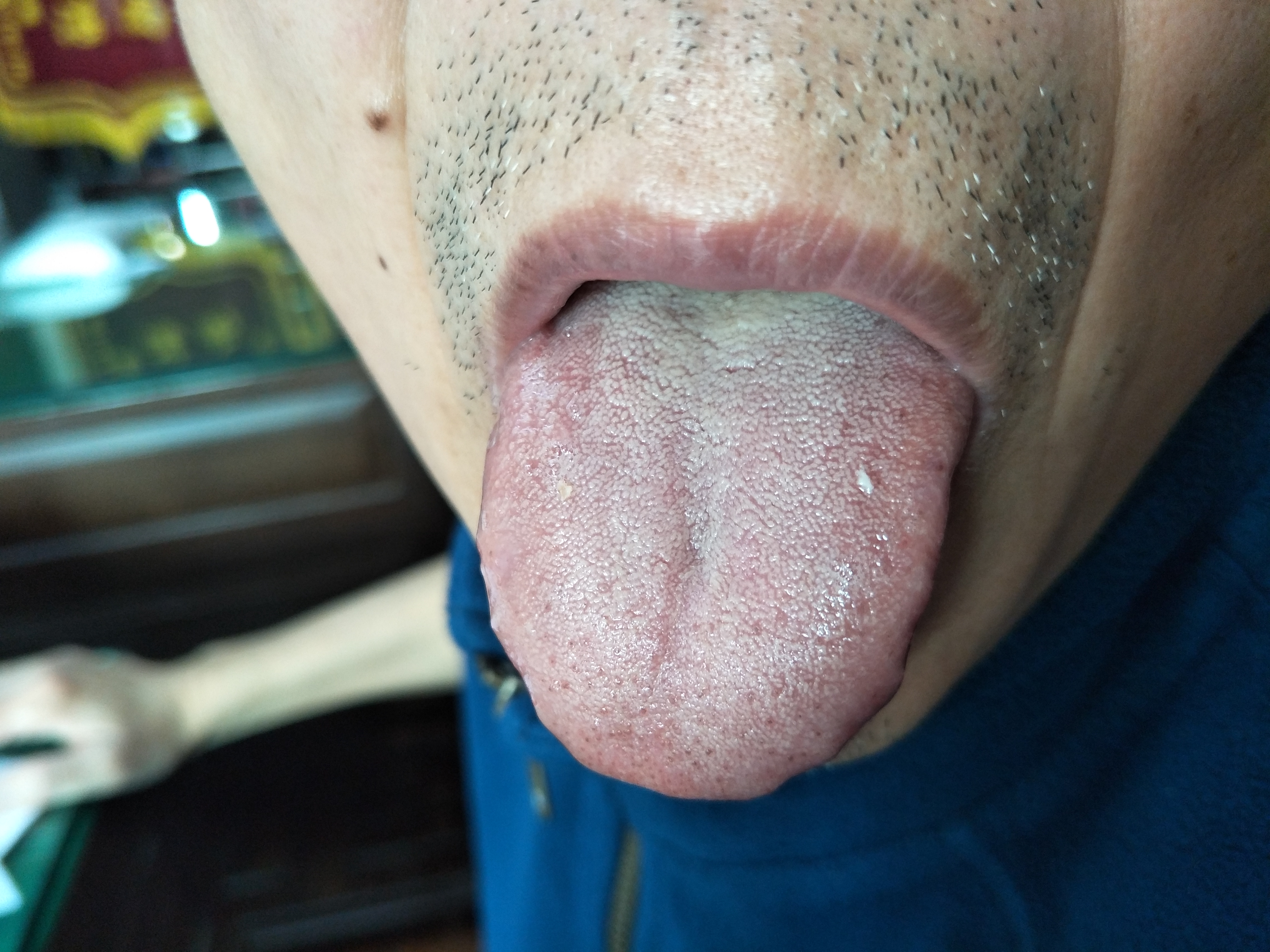 男，65岁，心悸6月 舌面.jpg