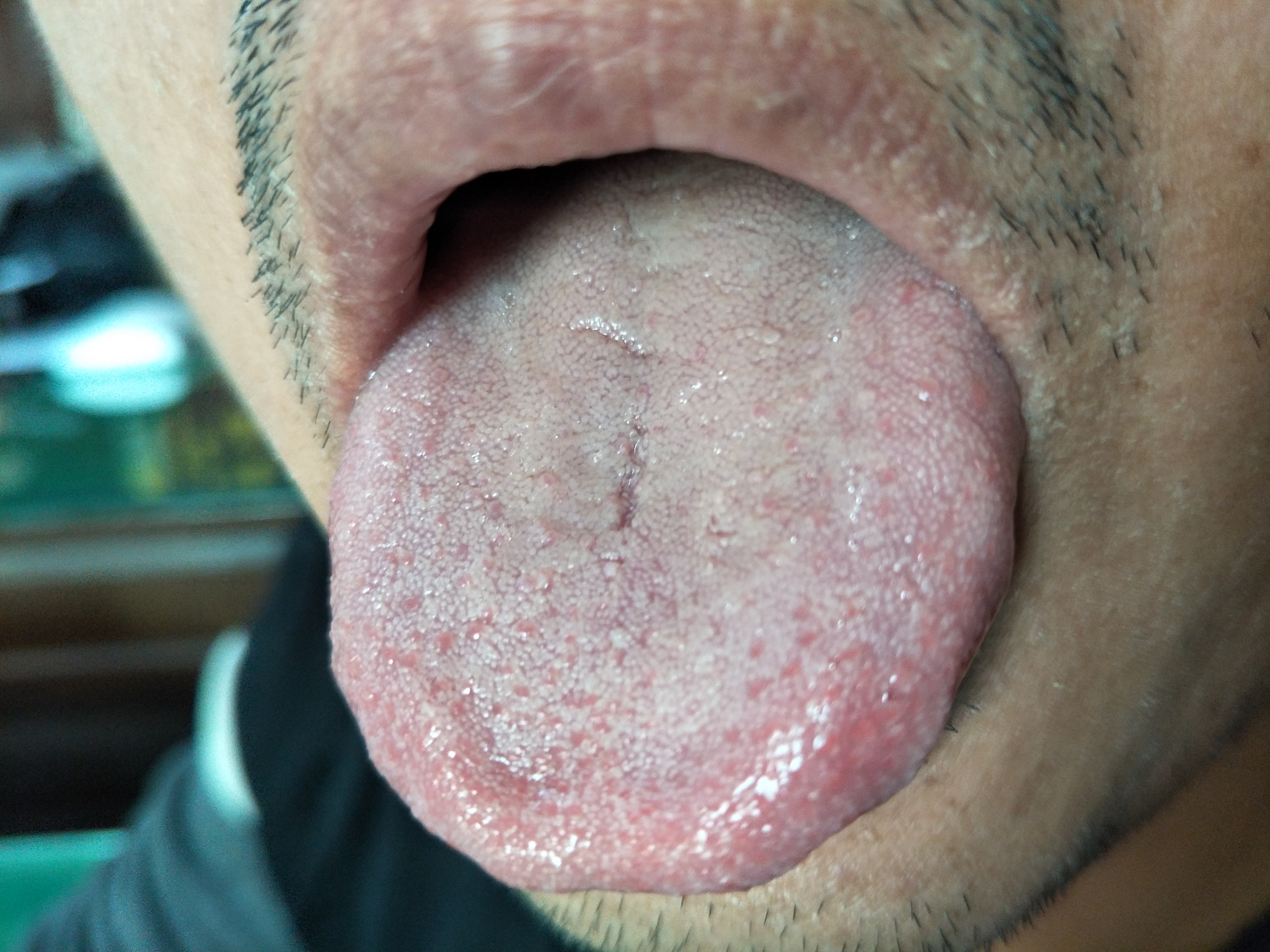 男，四肢多发湿疹6年 舌面.jpg