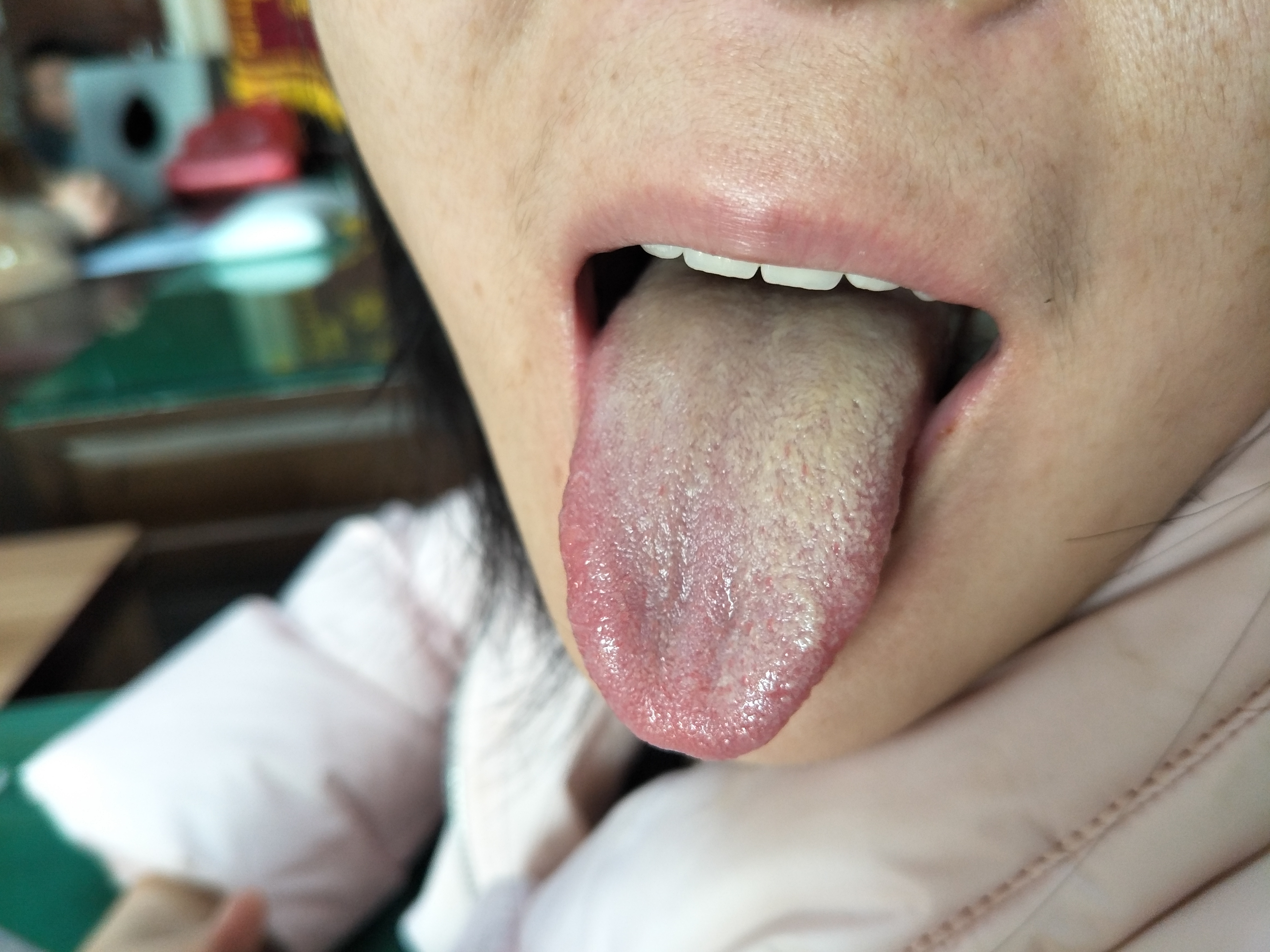 女，30岁，甲醛中毒后半年 舌面.jpg
