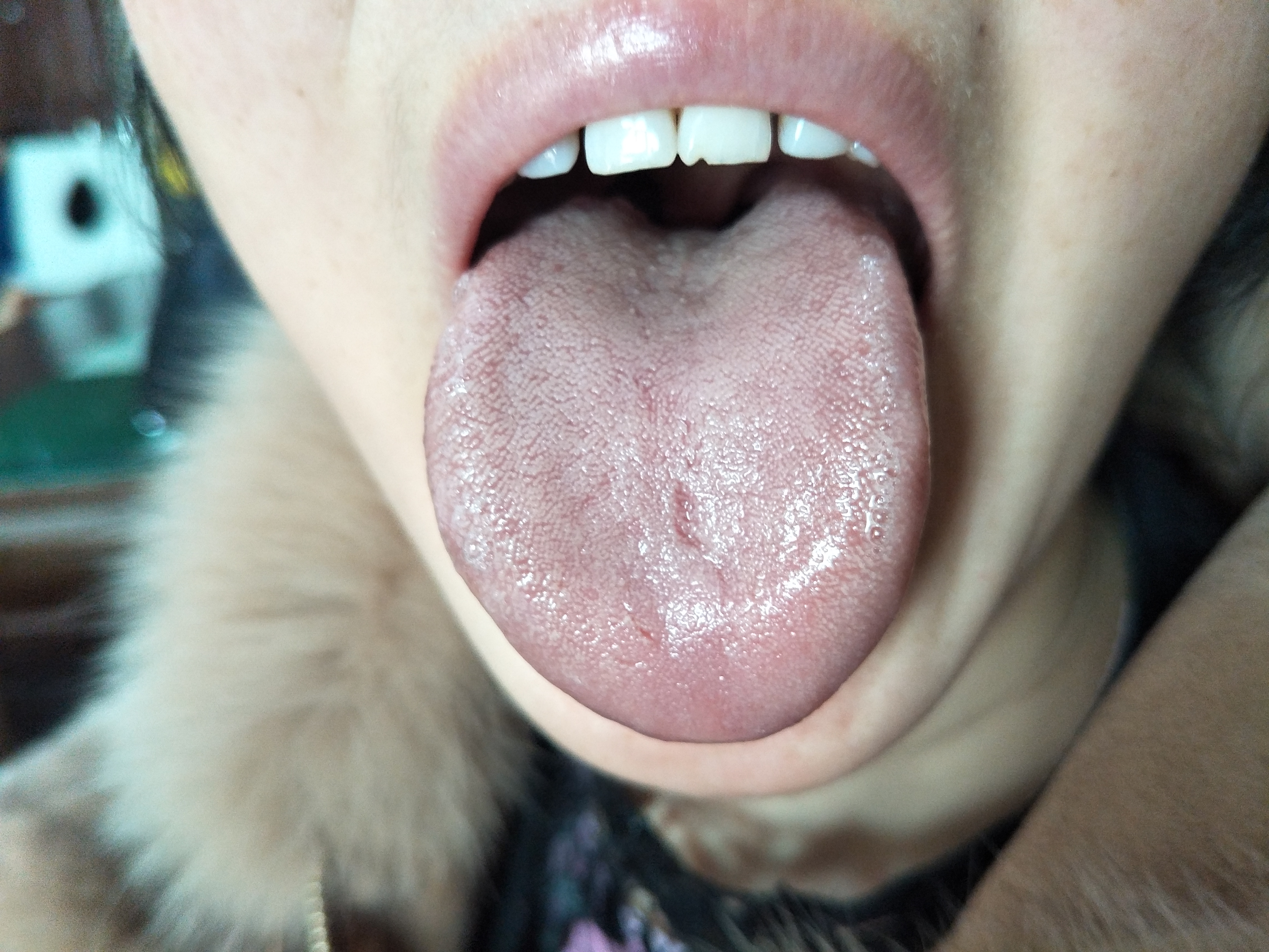 女，45岁，经期腹痛，畏寒2年余 舌面.jpg