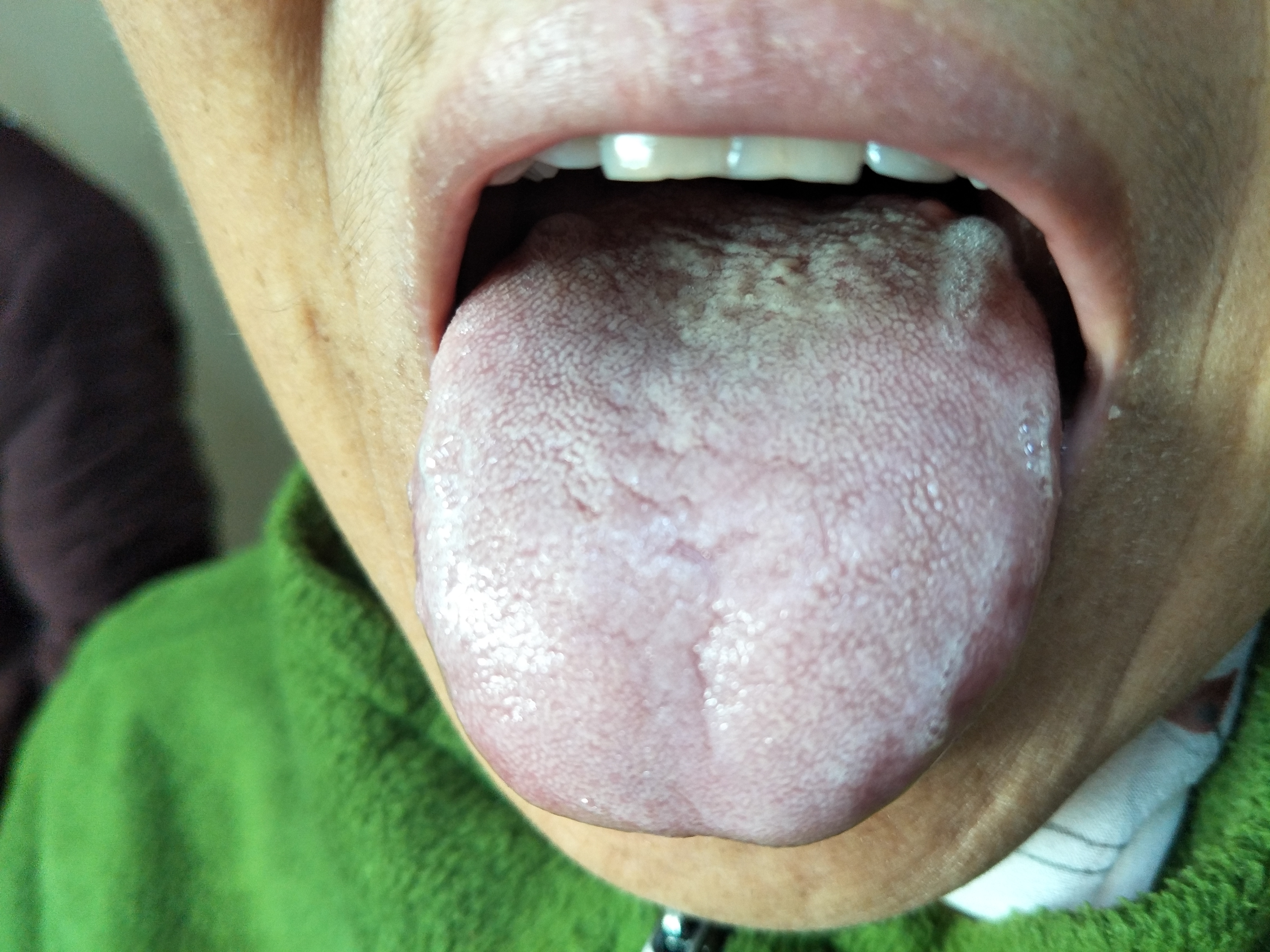 女，61岁，间断胃痛5年 舌面.jpg