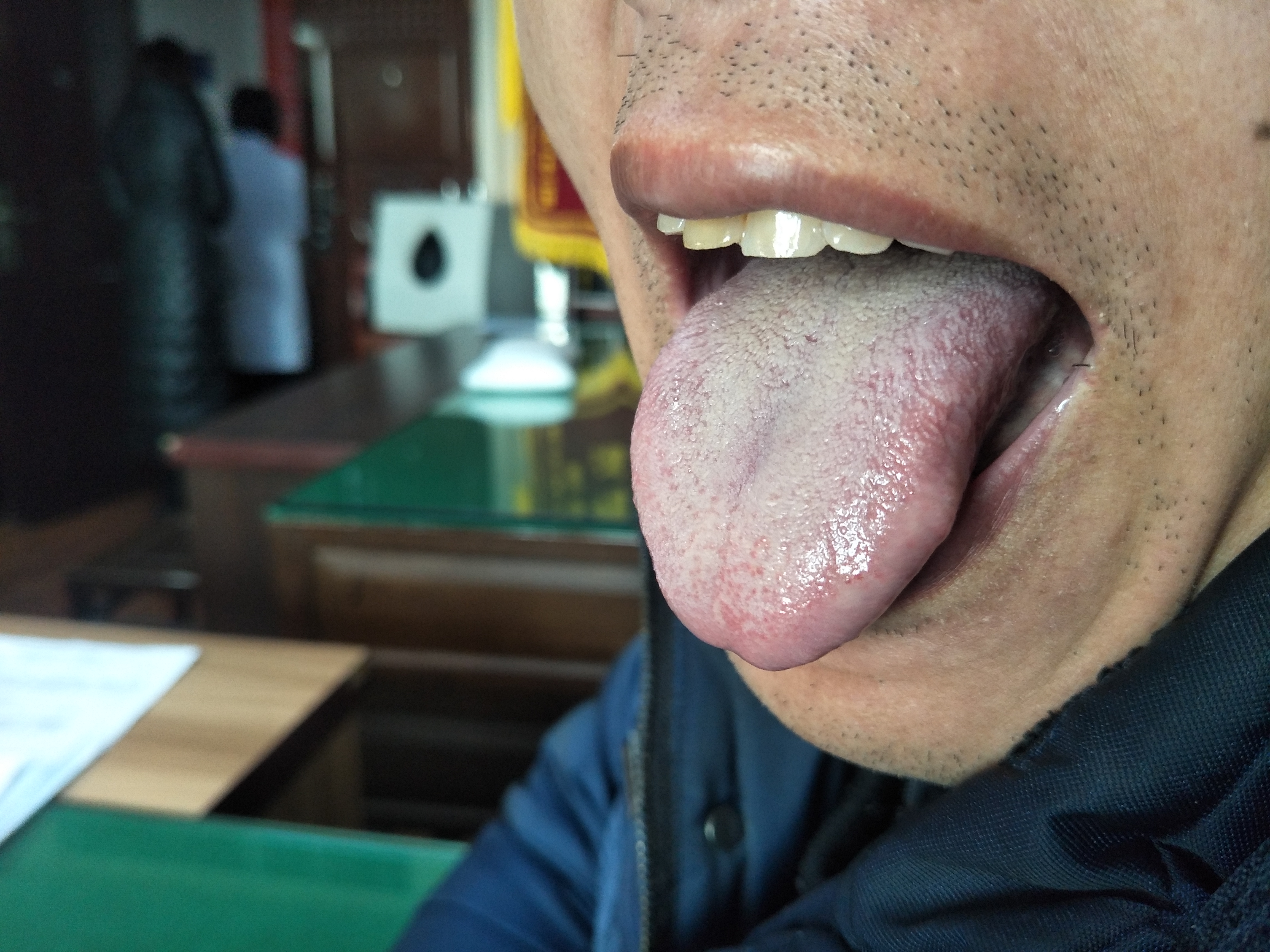 男，46岁，左肾恶性肿瘤术后半年余 舌面.jpg