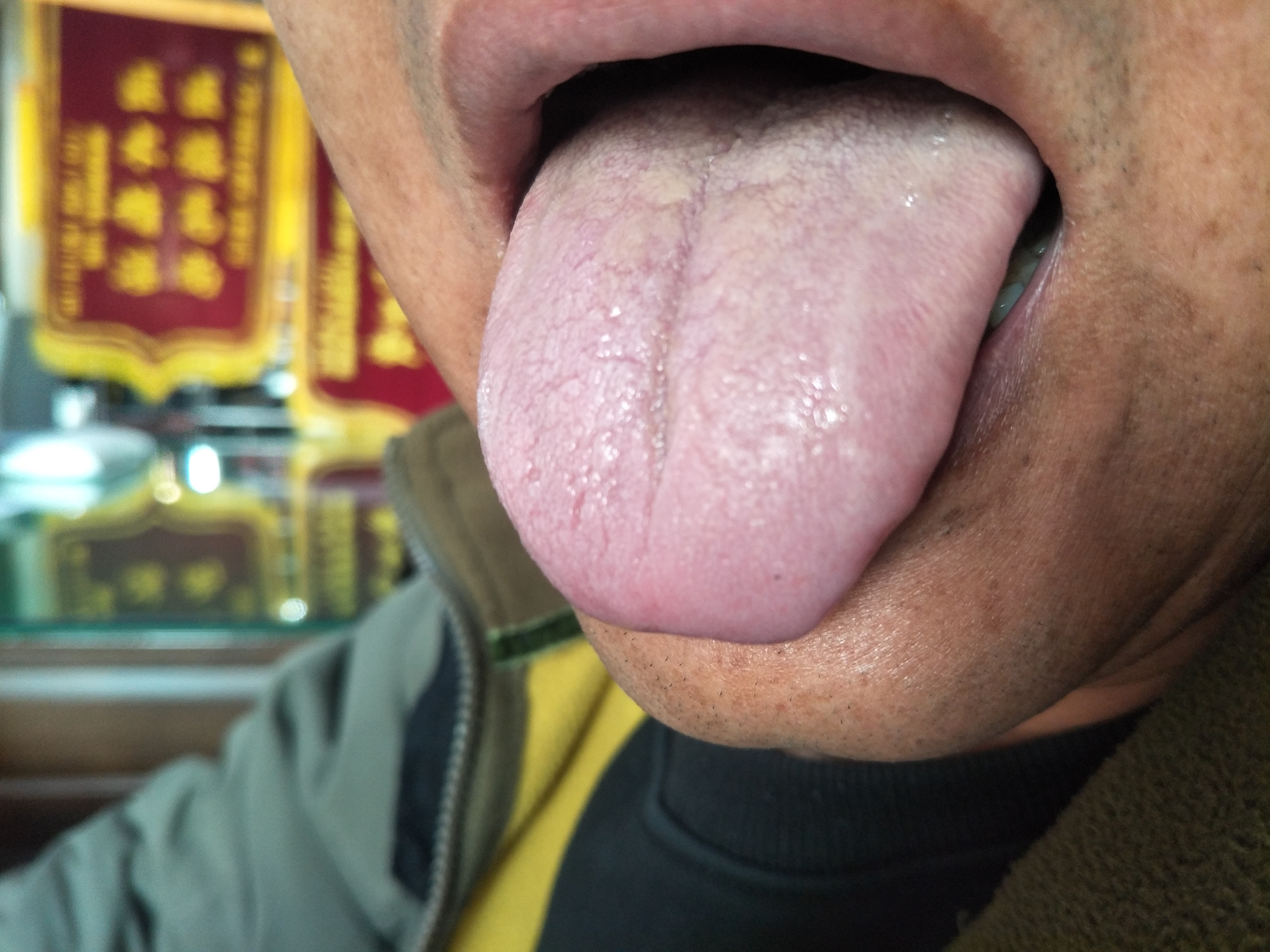 男，48岁，慢性萎缩性胃炎1年余 舌面.jpg