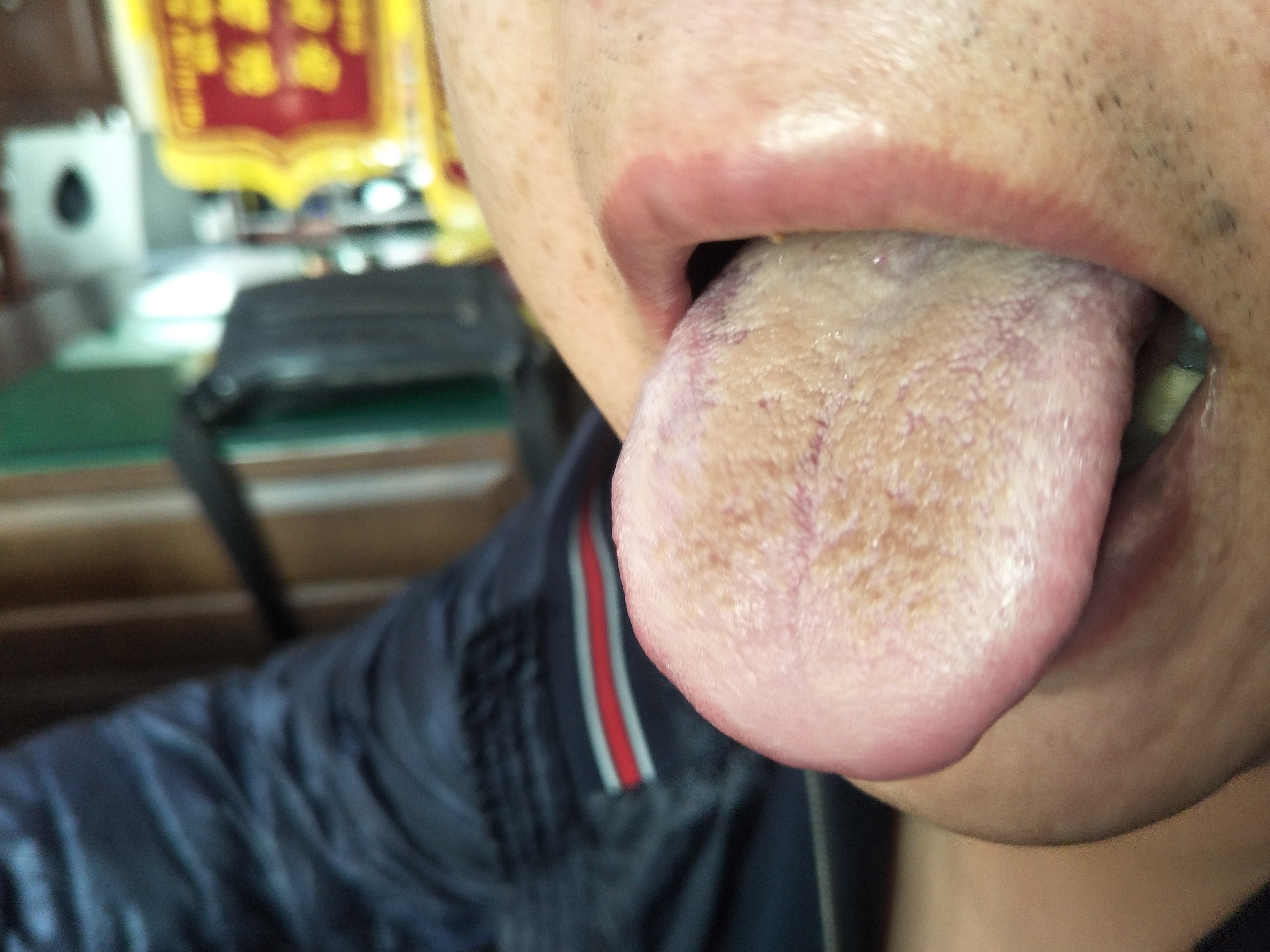 男，49岁，腹部反复多发囊肿近3年 舌面.jpg