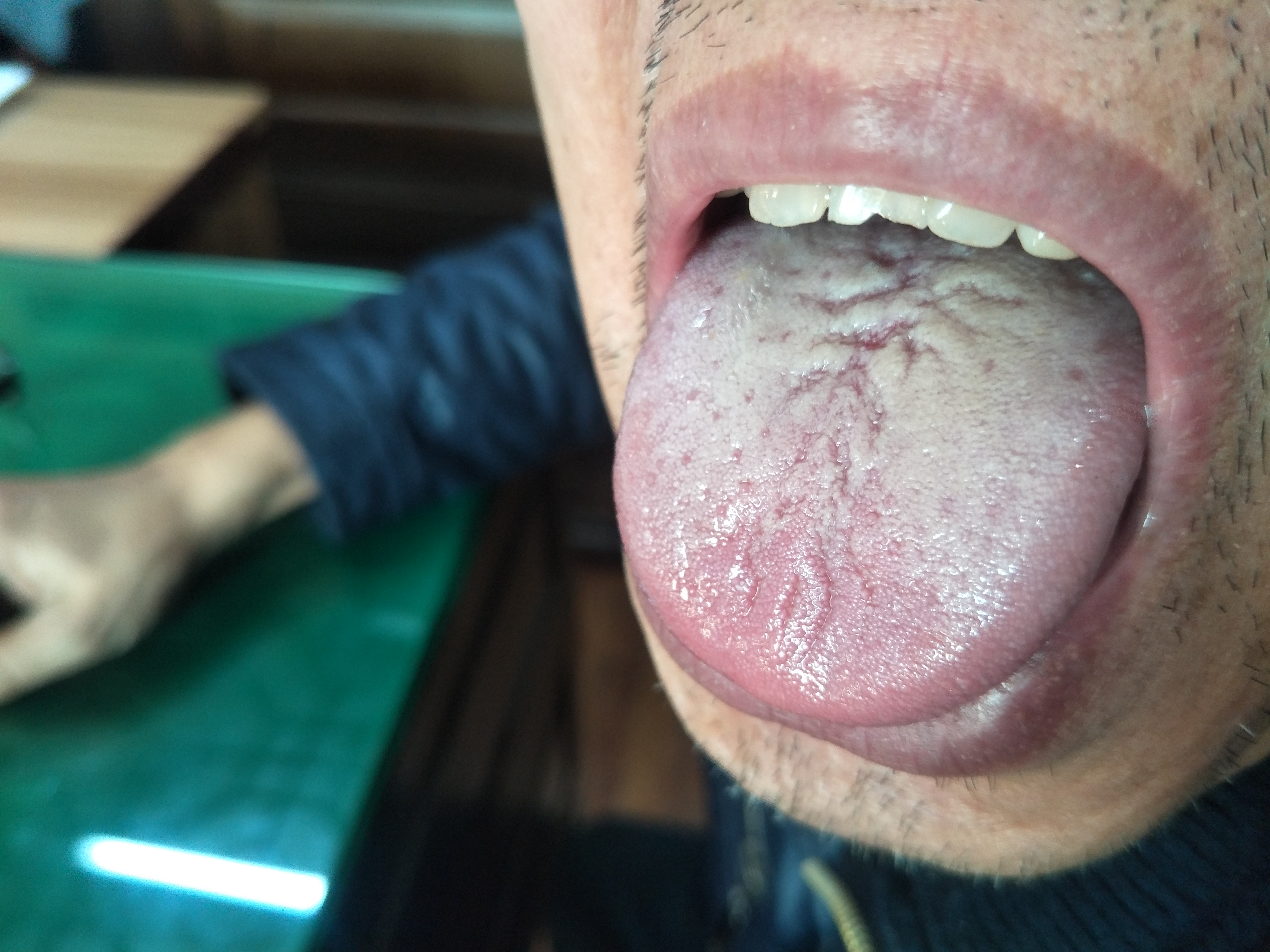 男，58岁，心慌胸闷近5年 舌面.jpg