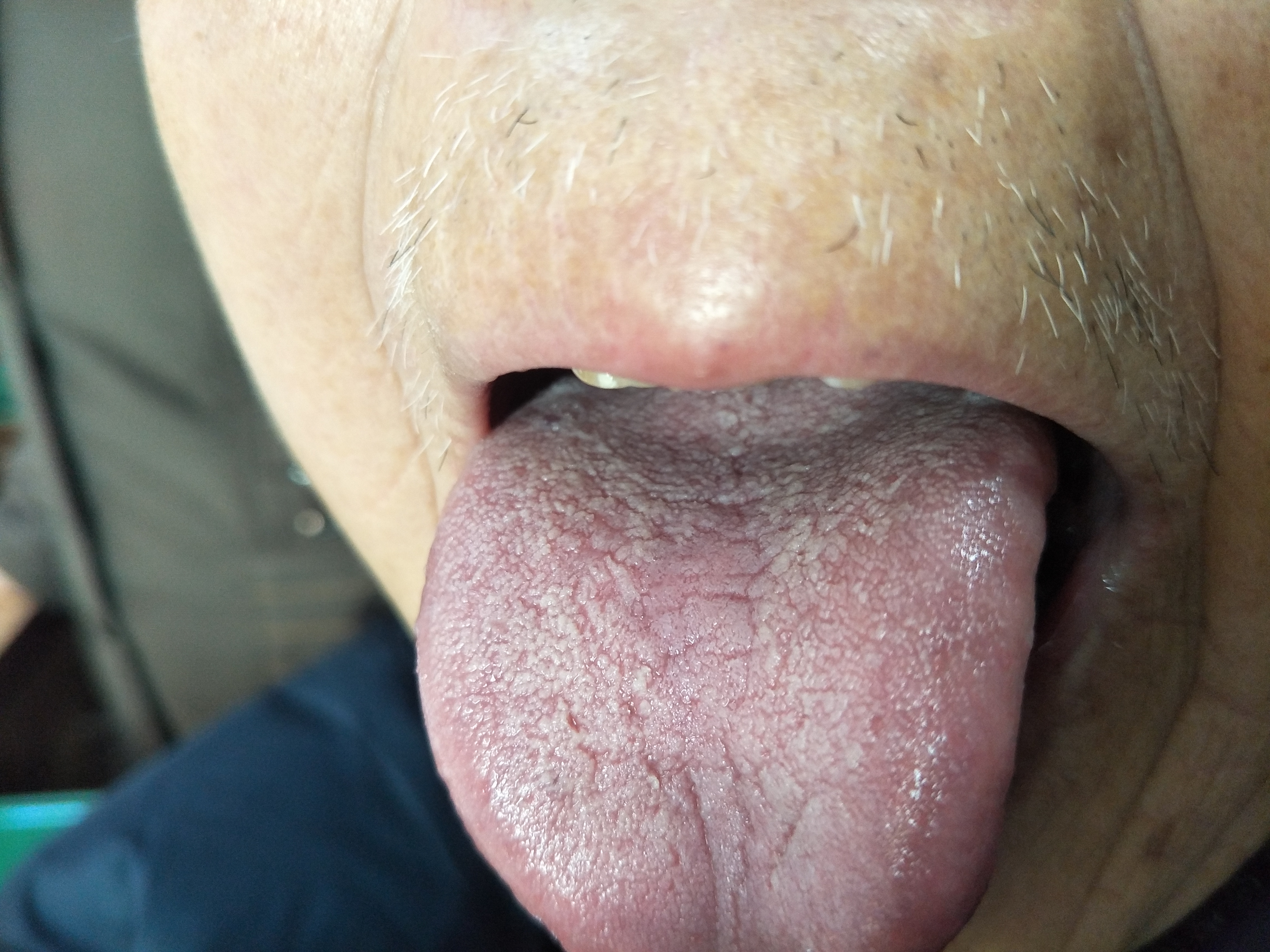 男，75岁，肺癌术后1年余 舌面.jpg