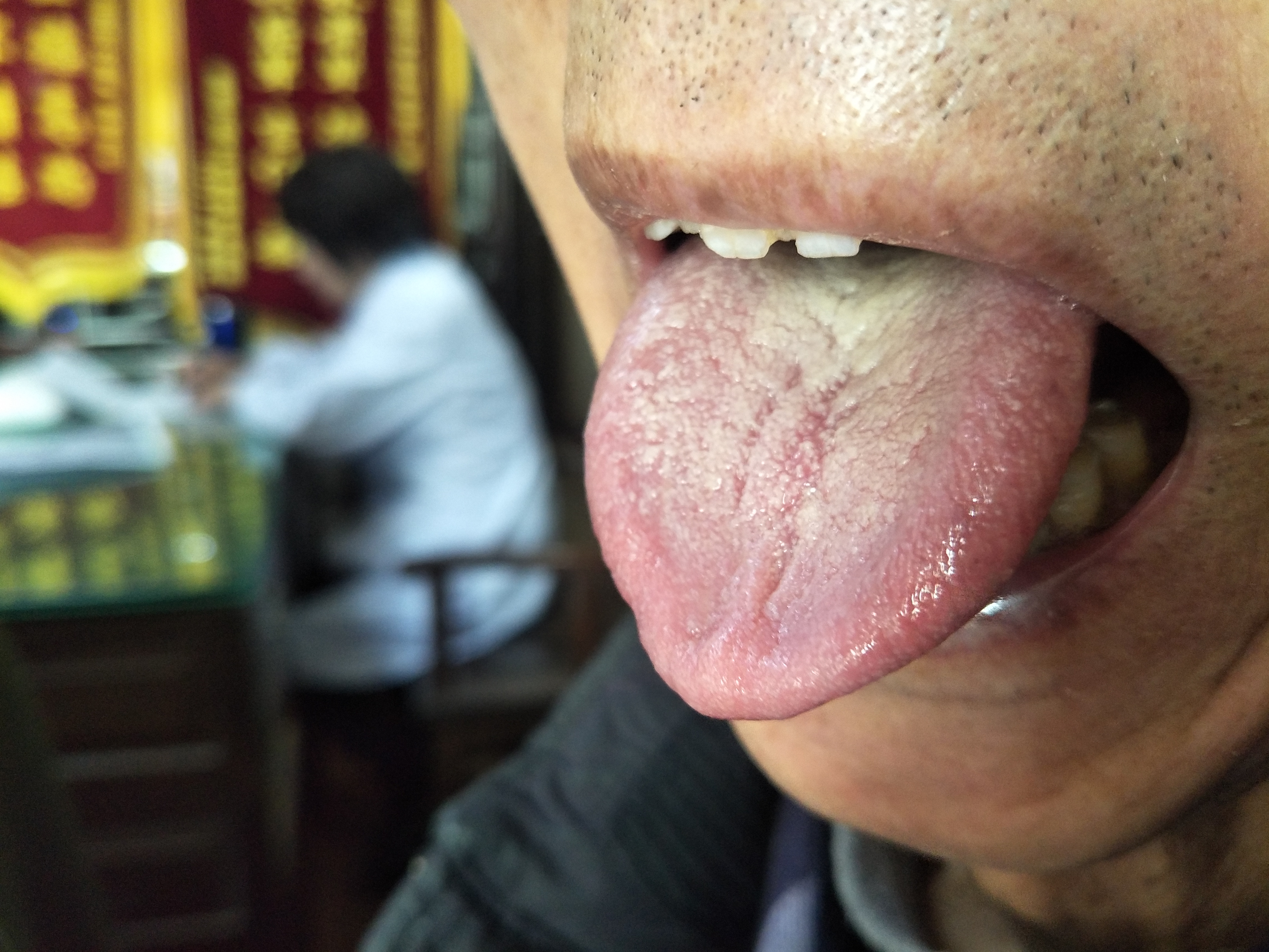 男，75岁，胃癌术后半年余 舌面.jpg