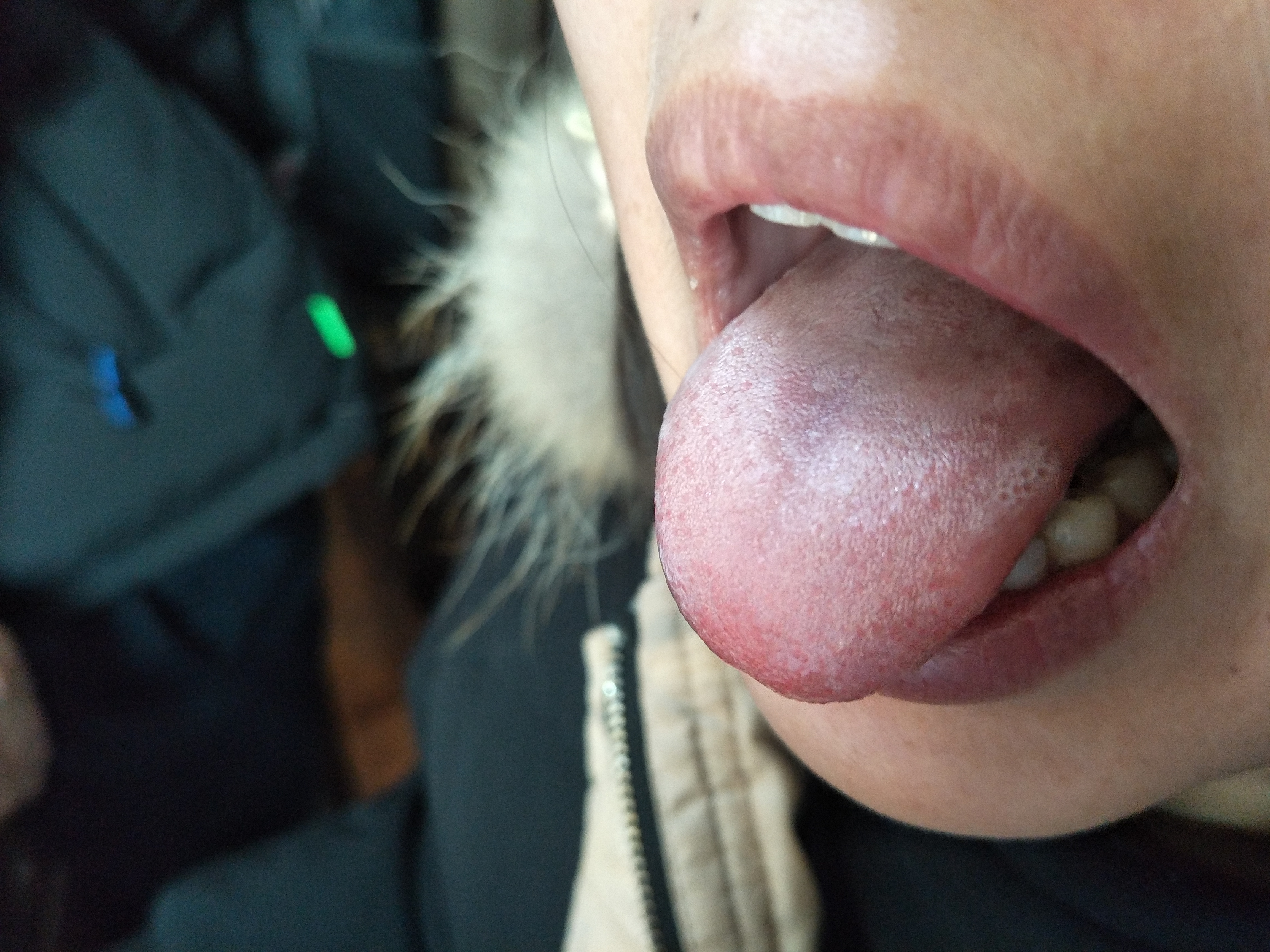 女，28岁，四肢乏力萎缩3年余 舌面.jpg