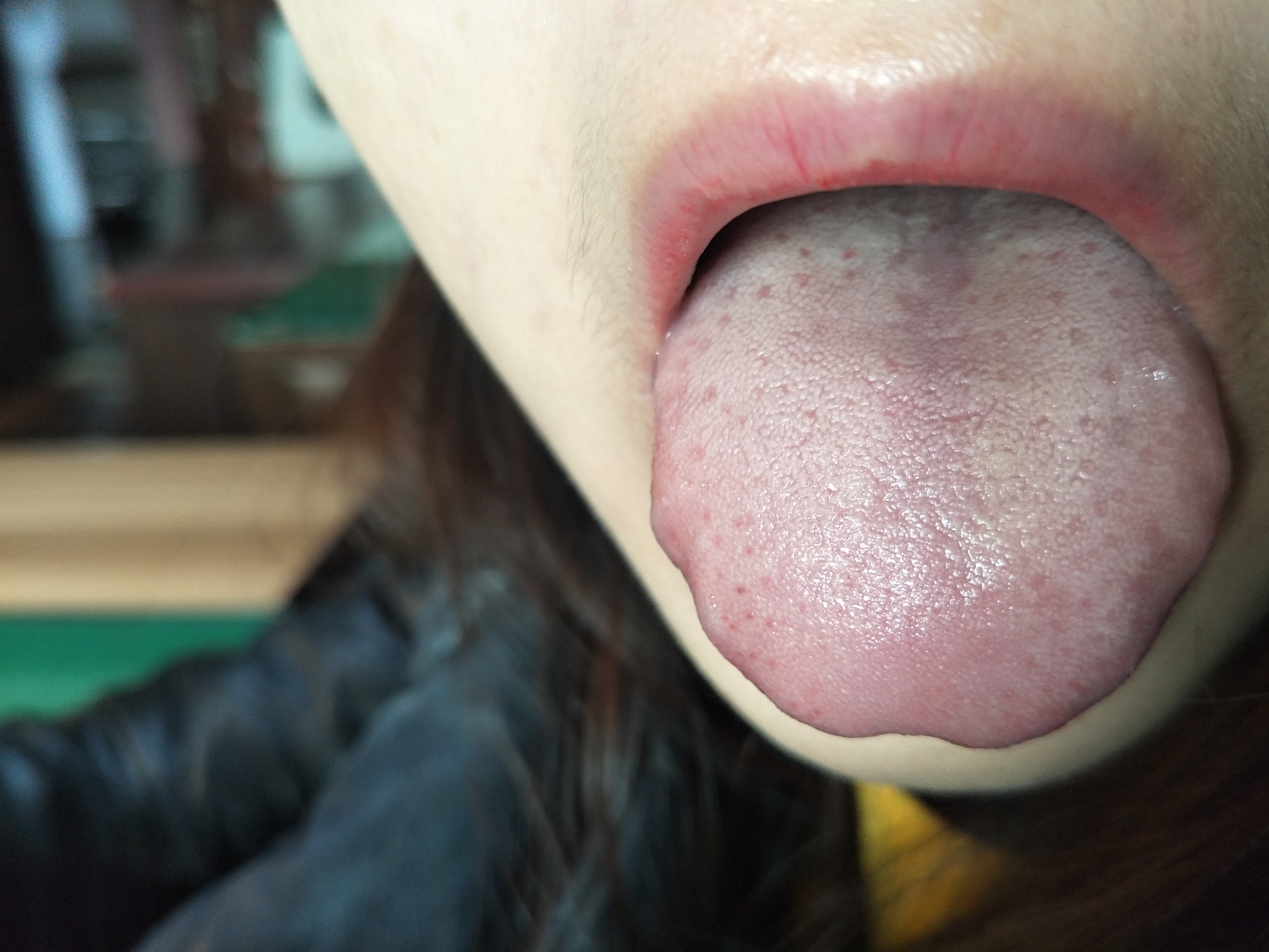 女，29岁，周身疼痛不适半年余 舌下.jpg