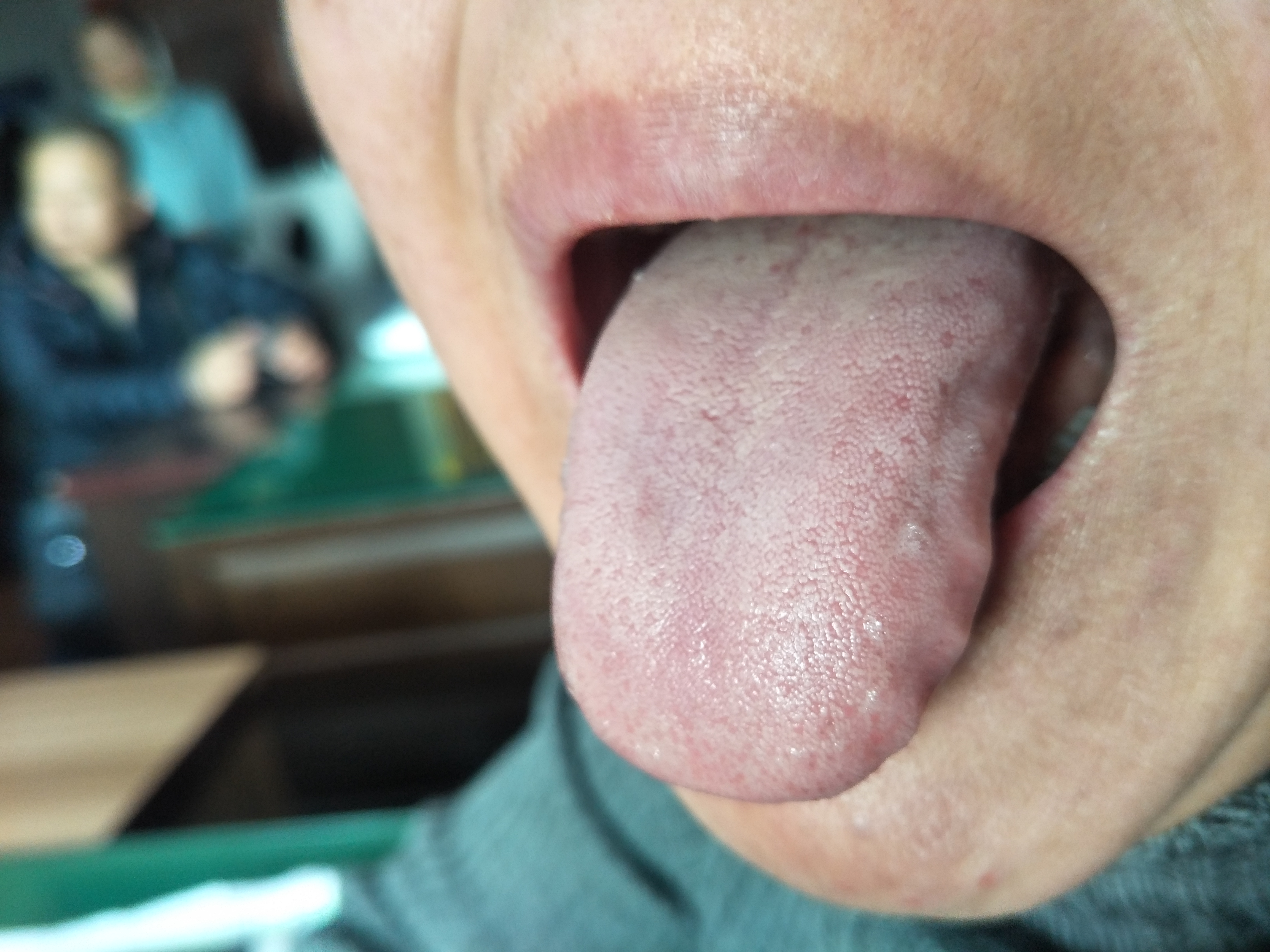 女，44岁，不孕10年 舌面.jpg