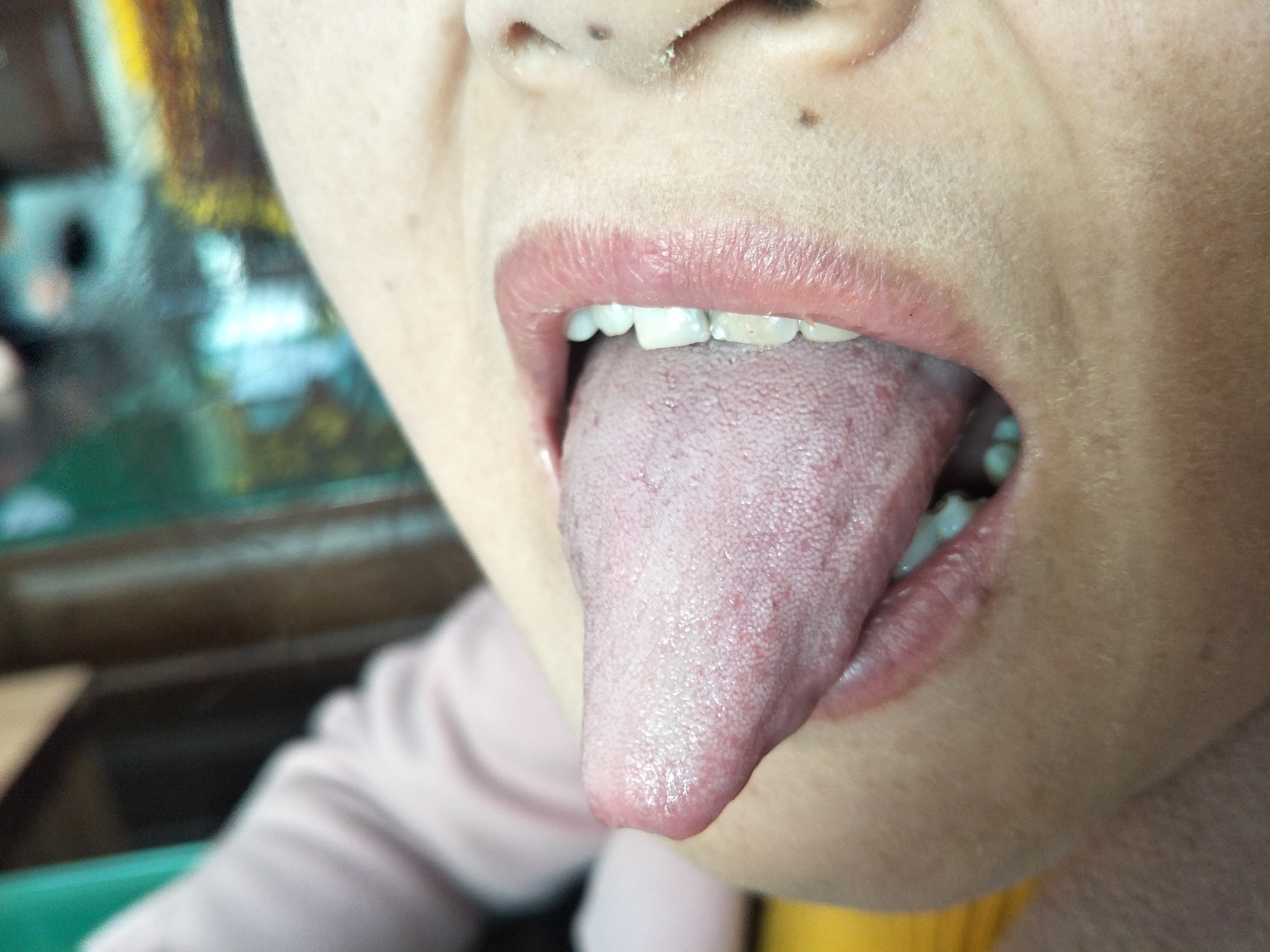 女，52岁，夜间难以入睡10余年 舌面.jpg