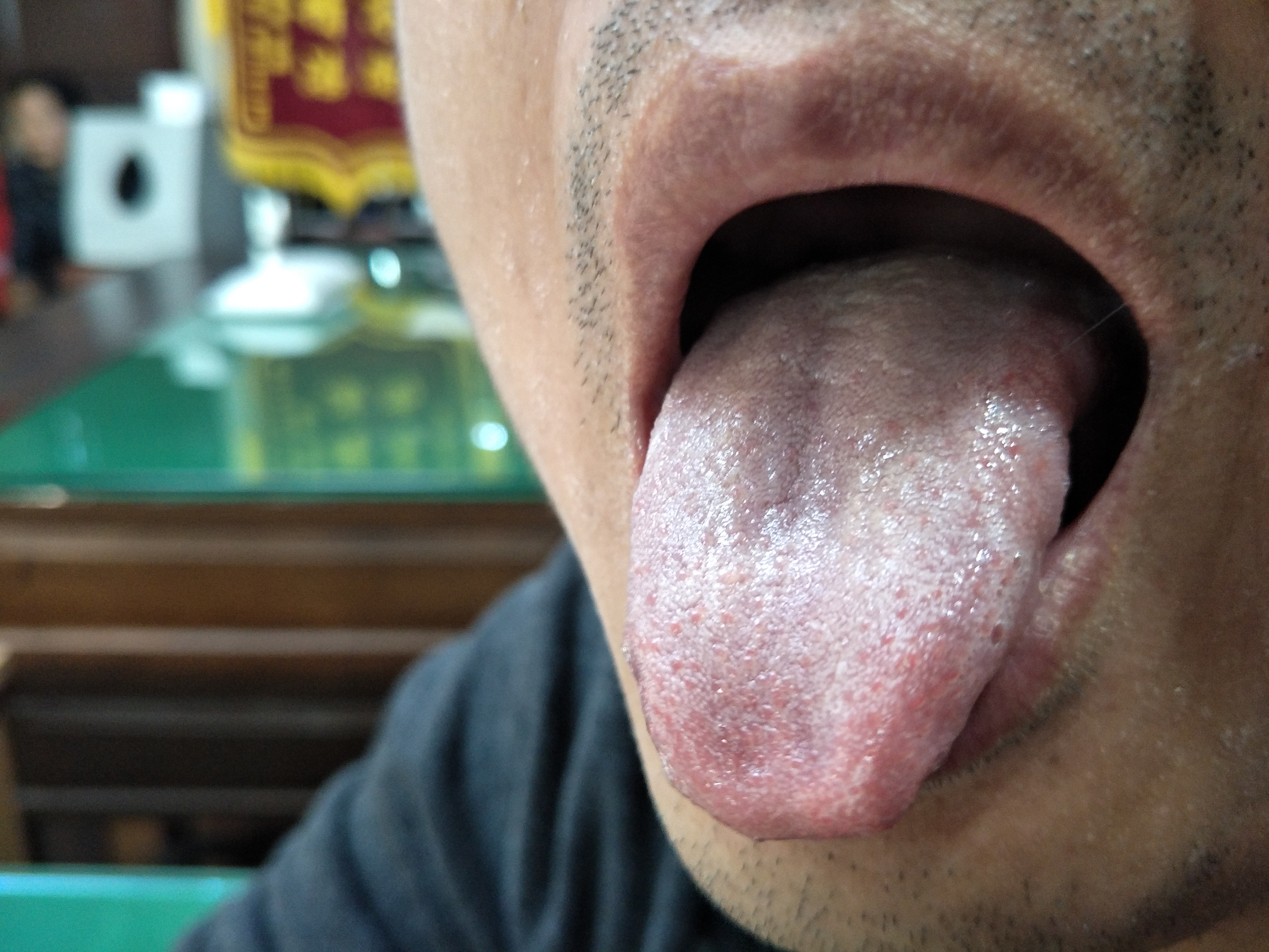 男，35岁，四肢多发湿疹6年 舌面.jpg