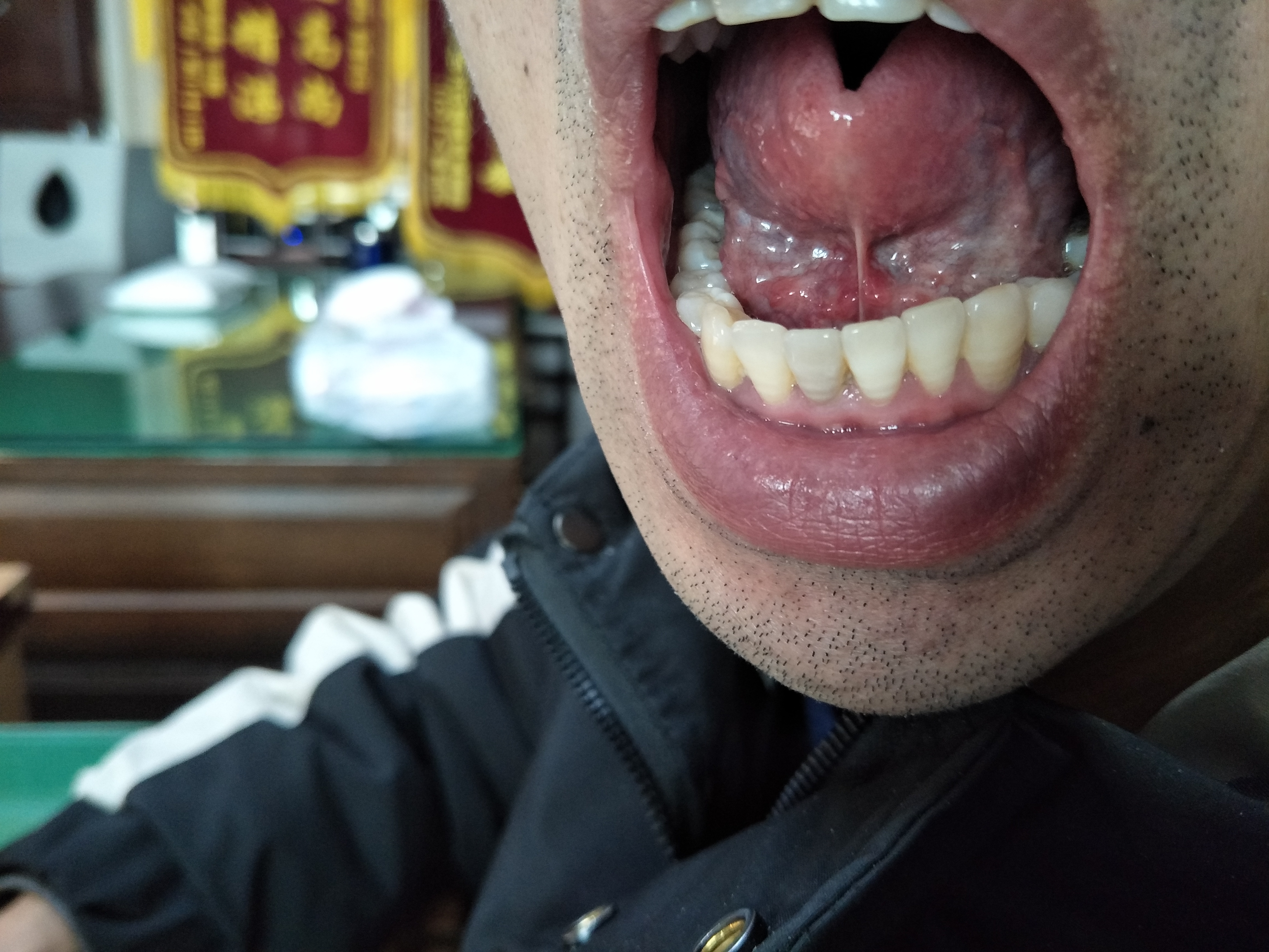 男，40岁，胃脘部胀满不适5年余 舌下.jpg