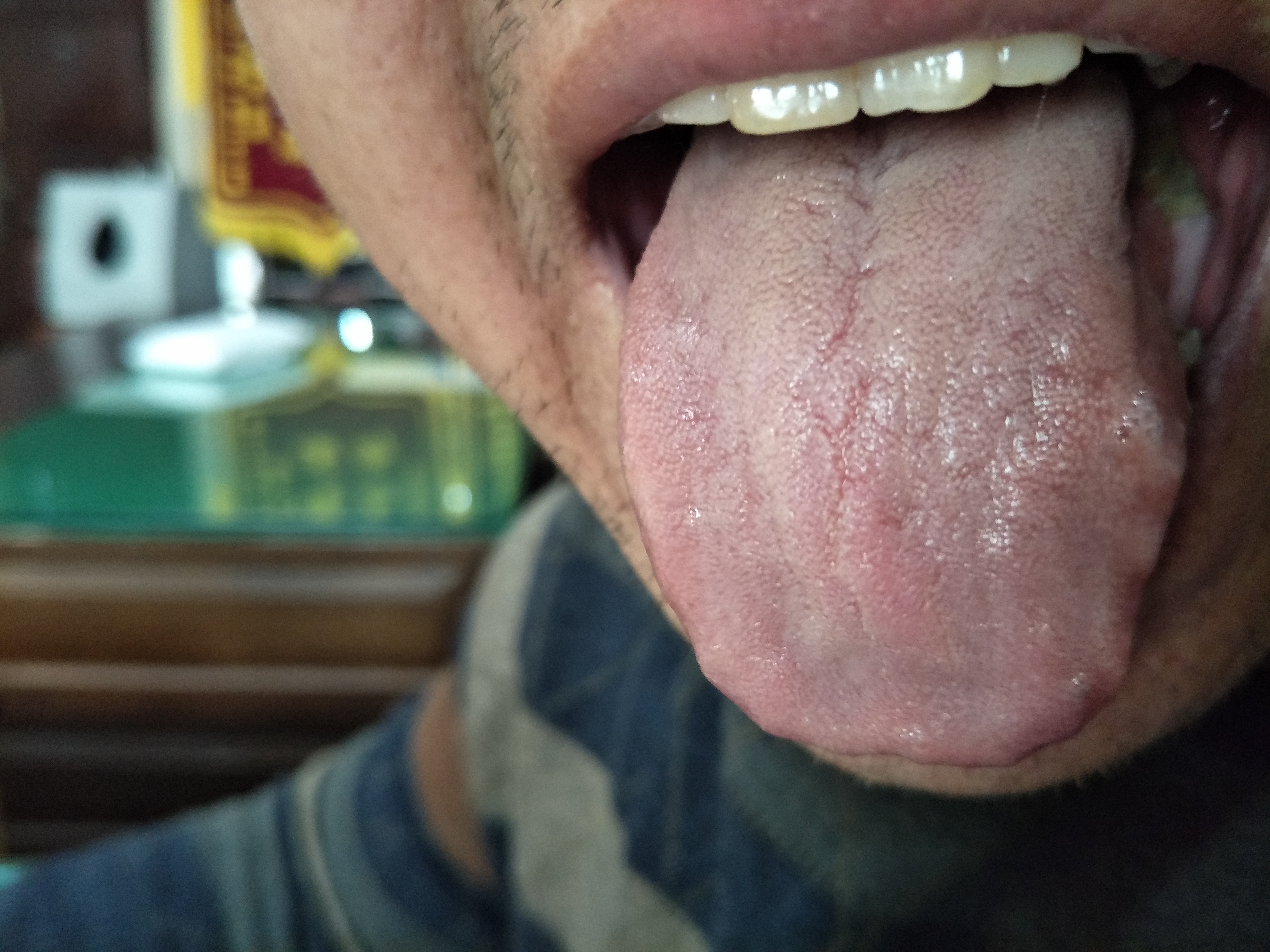 男，43岁，间断肺部不适4年余 舌面.jpg