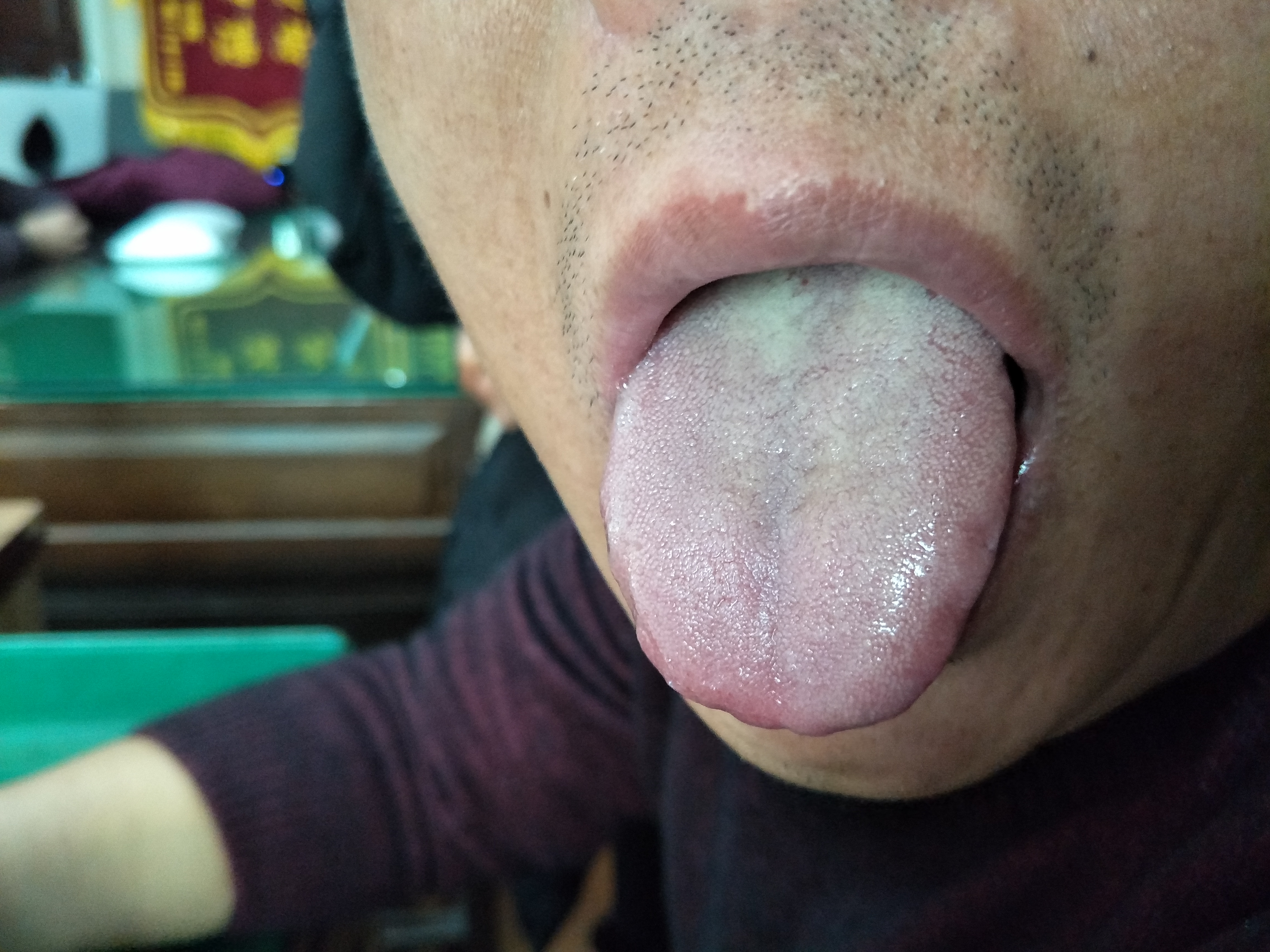 男，43岁，畏寒，盗汗10年余 舌面.jpg