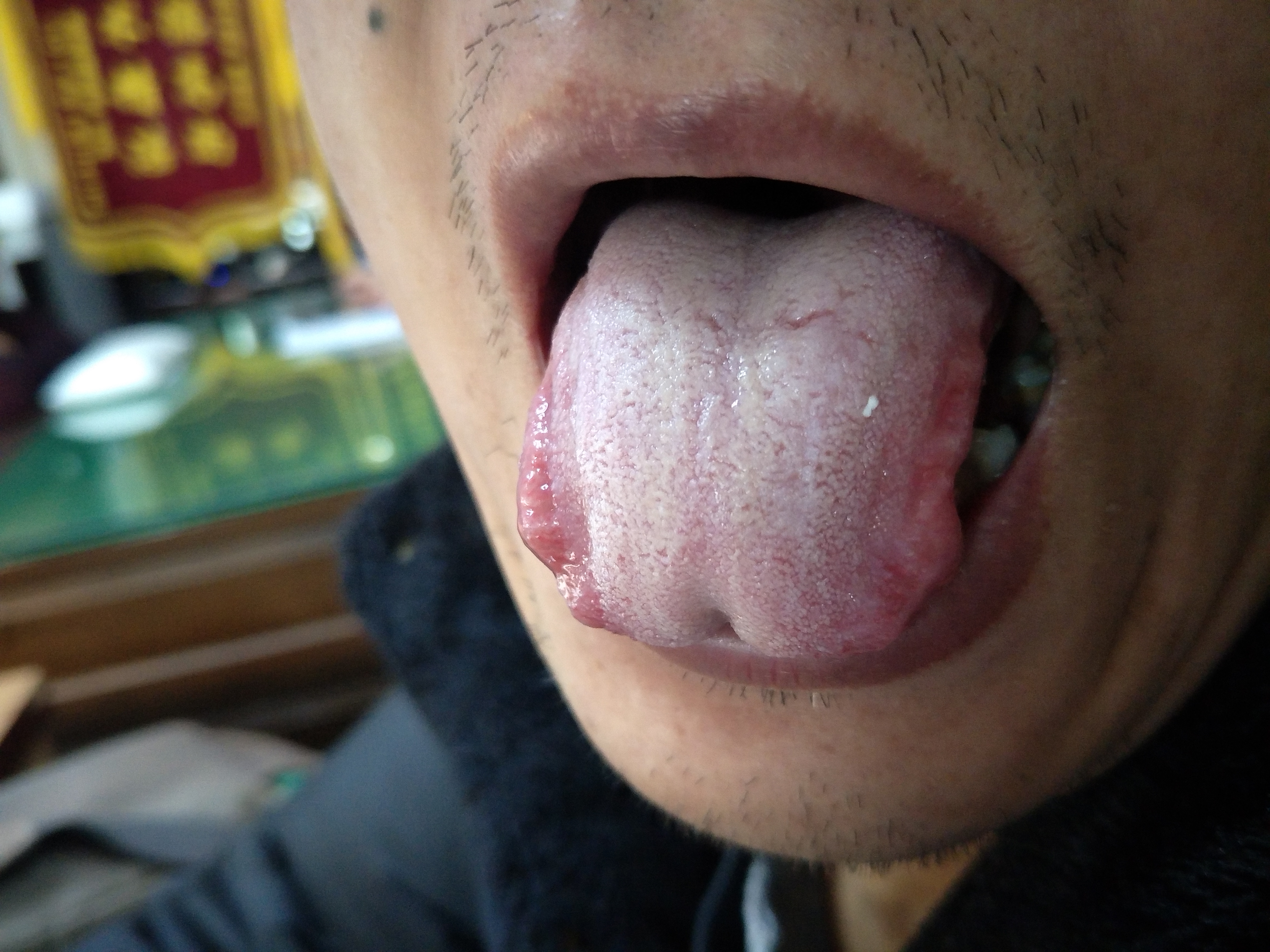 男，49岁，全身肌肉酸胀疼痛6年余 舌面.jpg