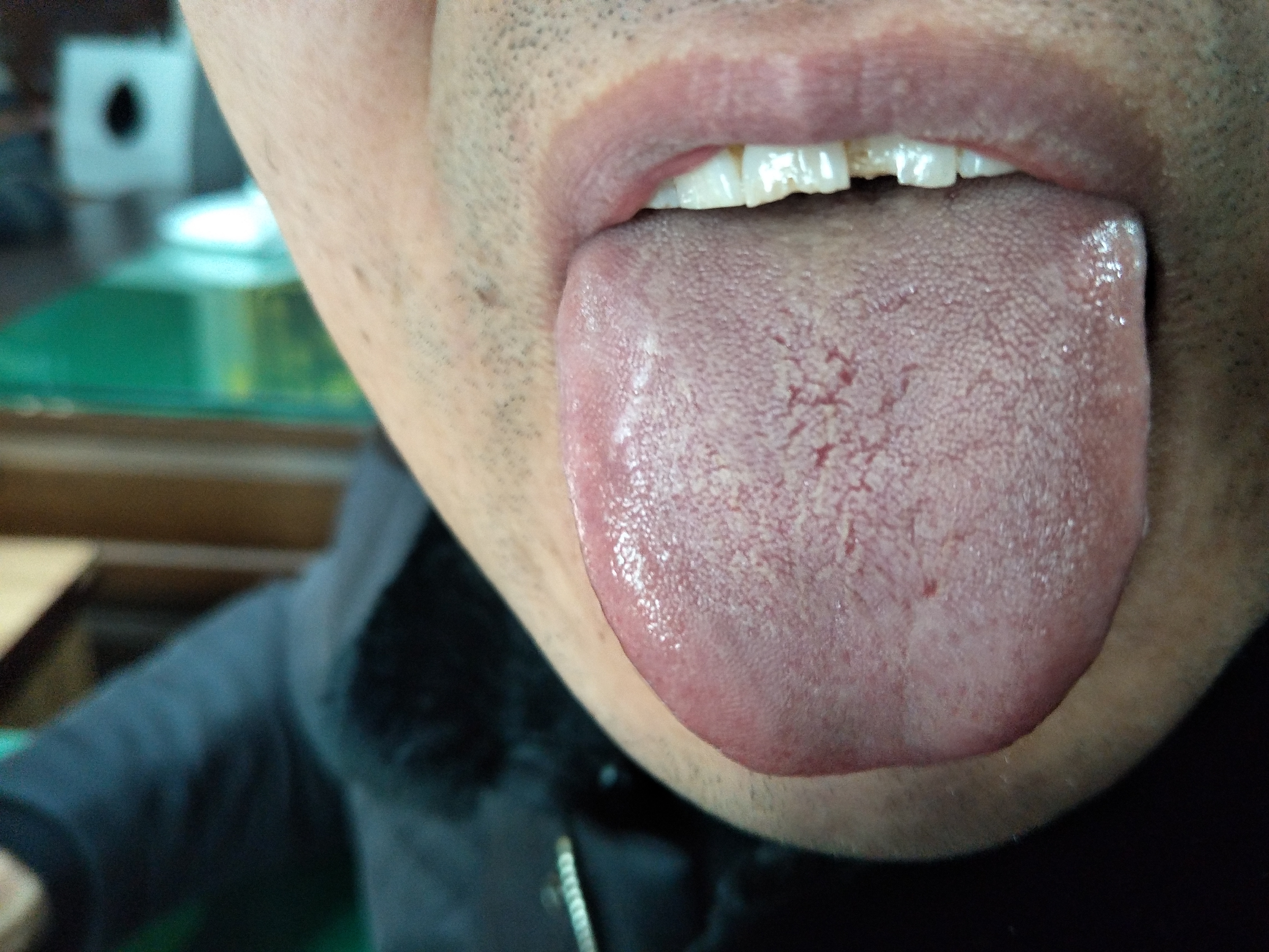 男，49岁，性欲低下1年 舌面.jpg