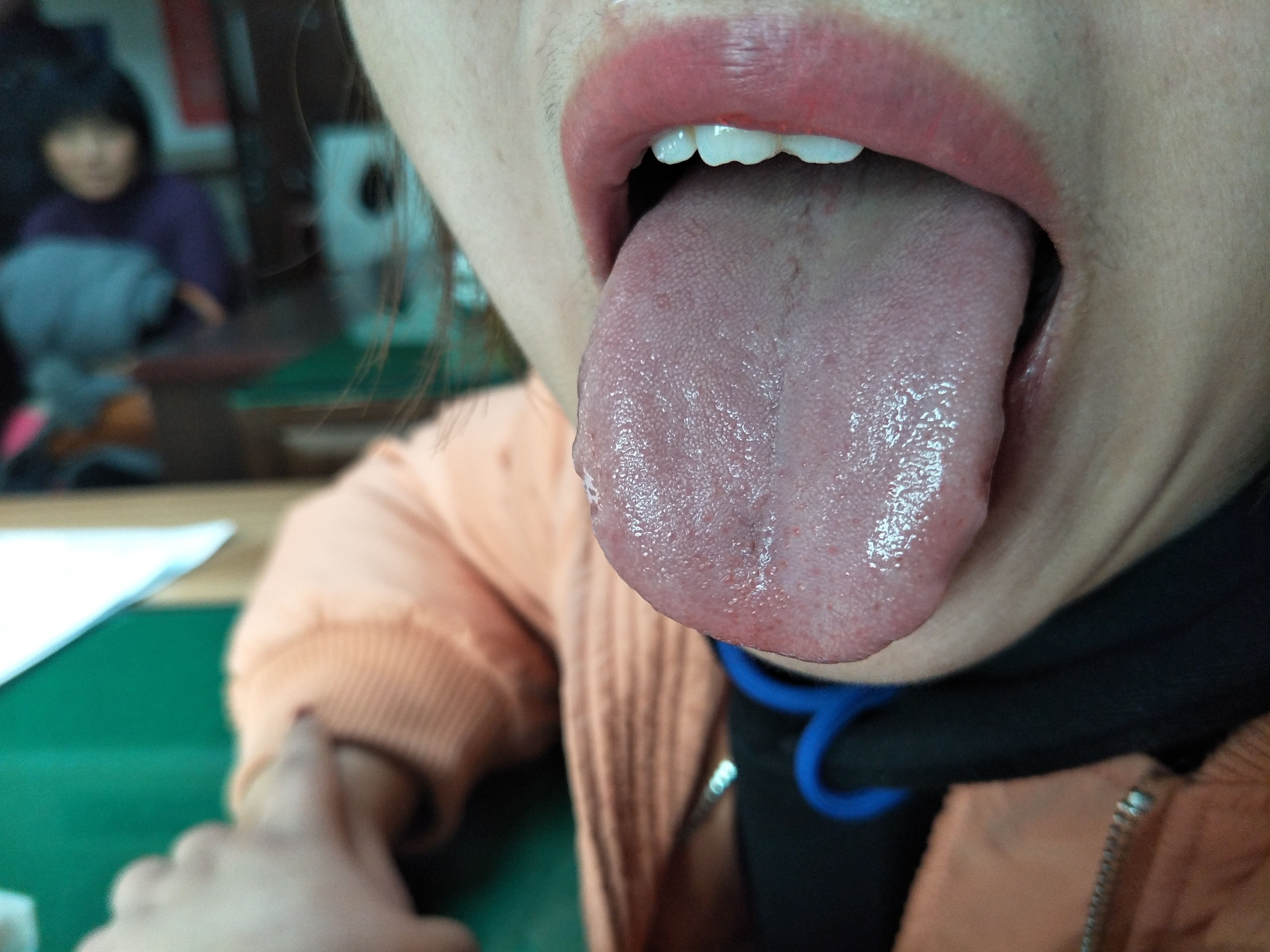 女，35岁，月经量少3年 舌面.jpg