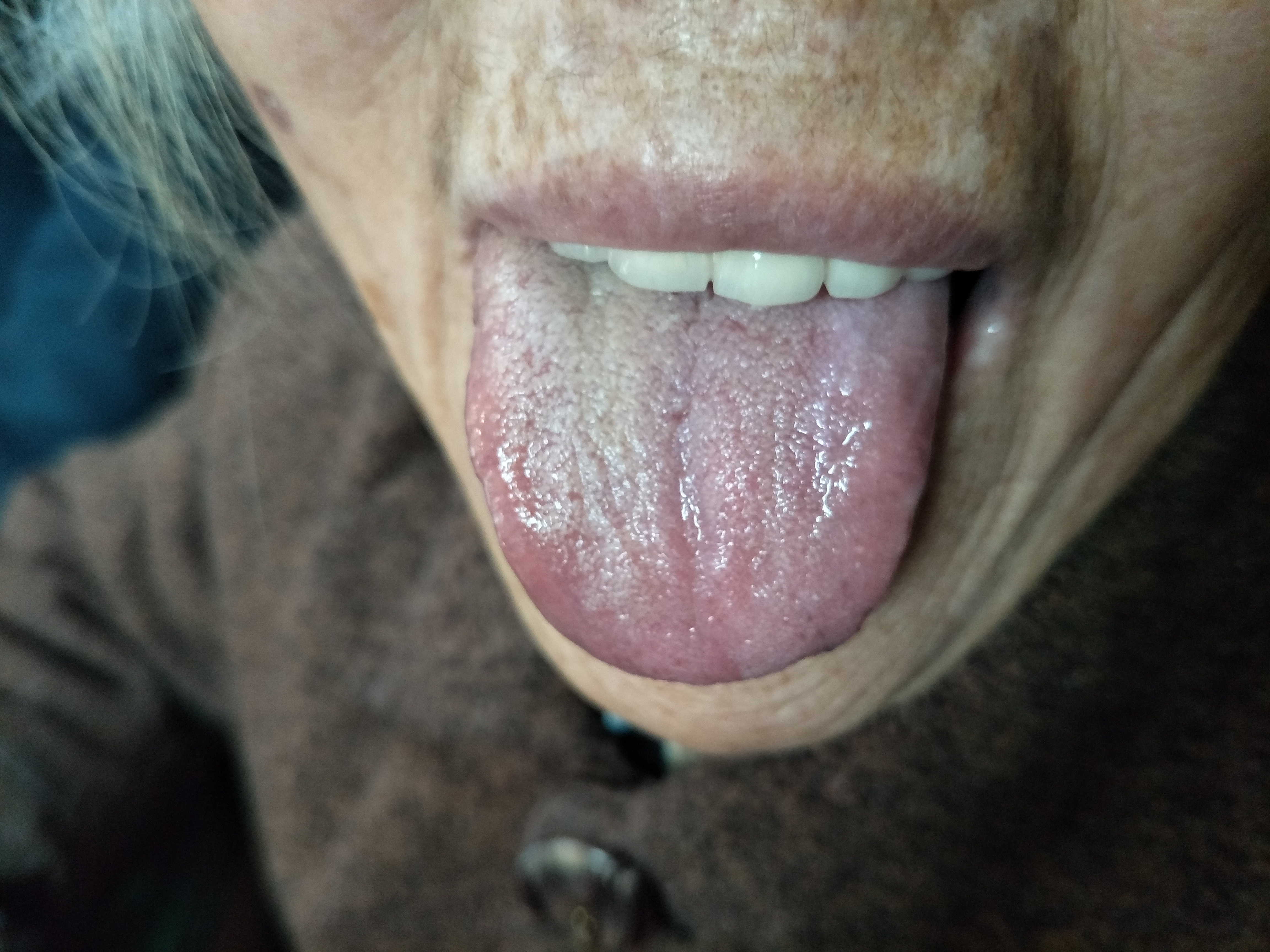 女，82岁，胃脘部不适30余年 舌面.jpg