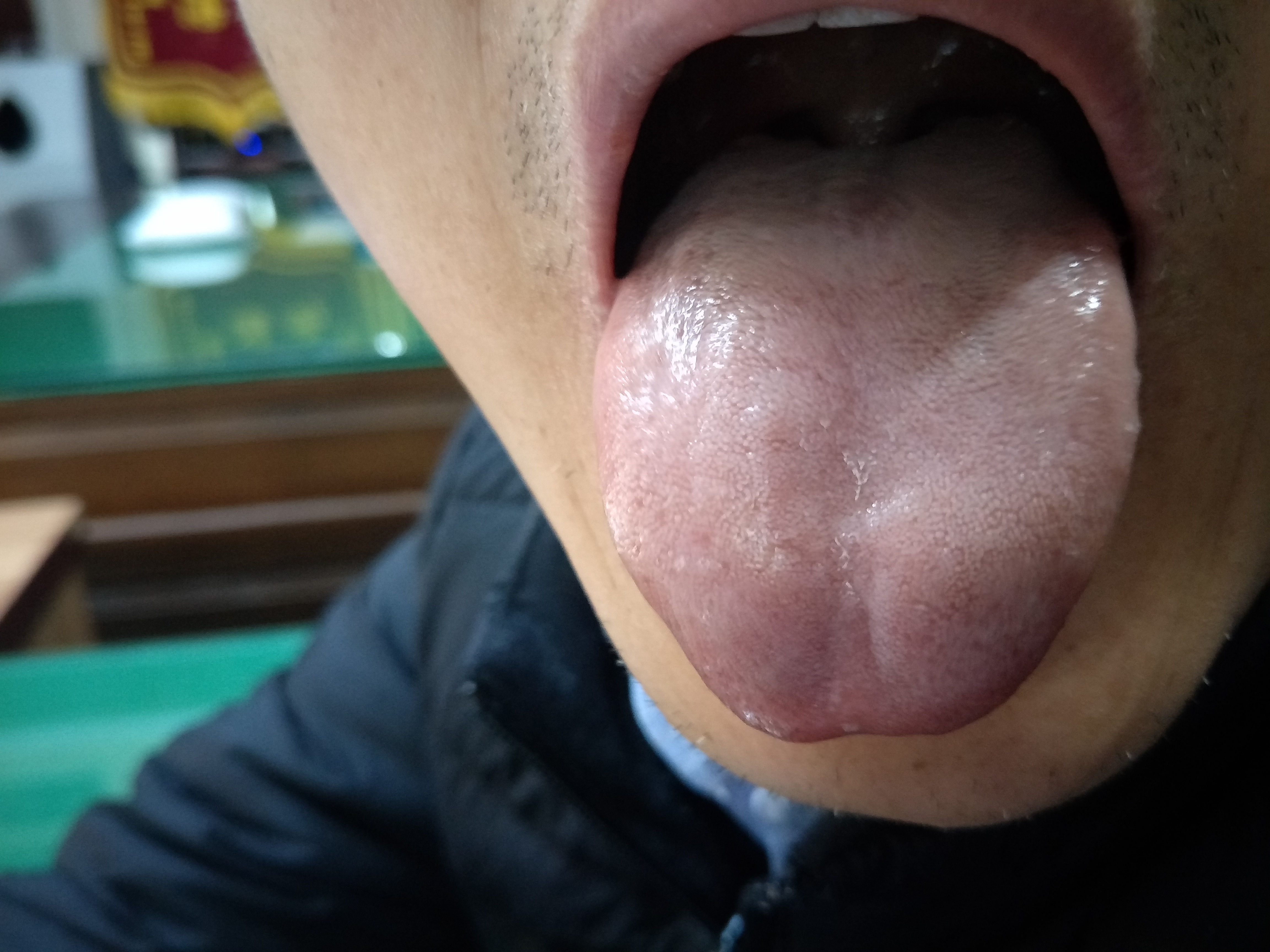 男，53岁，胃脘部隐痛5年余 舌面.jpg