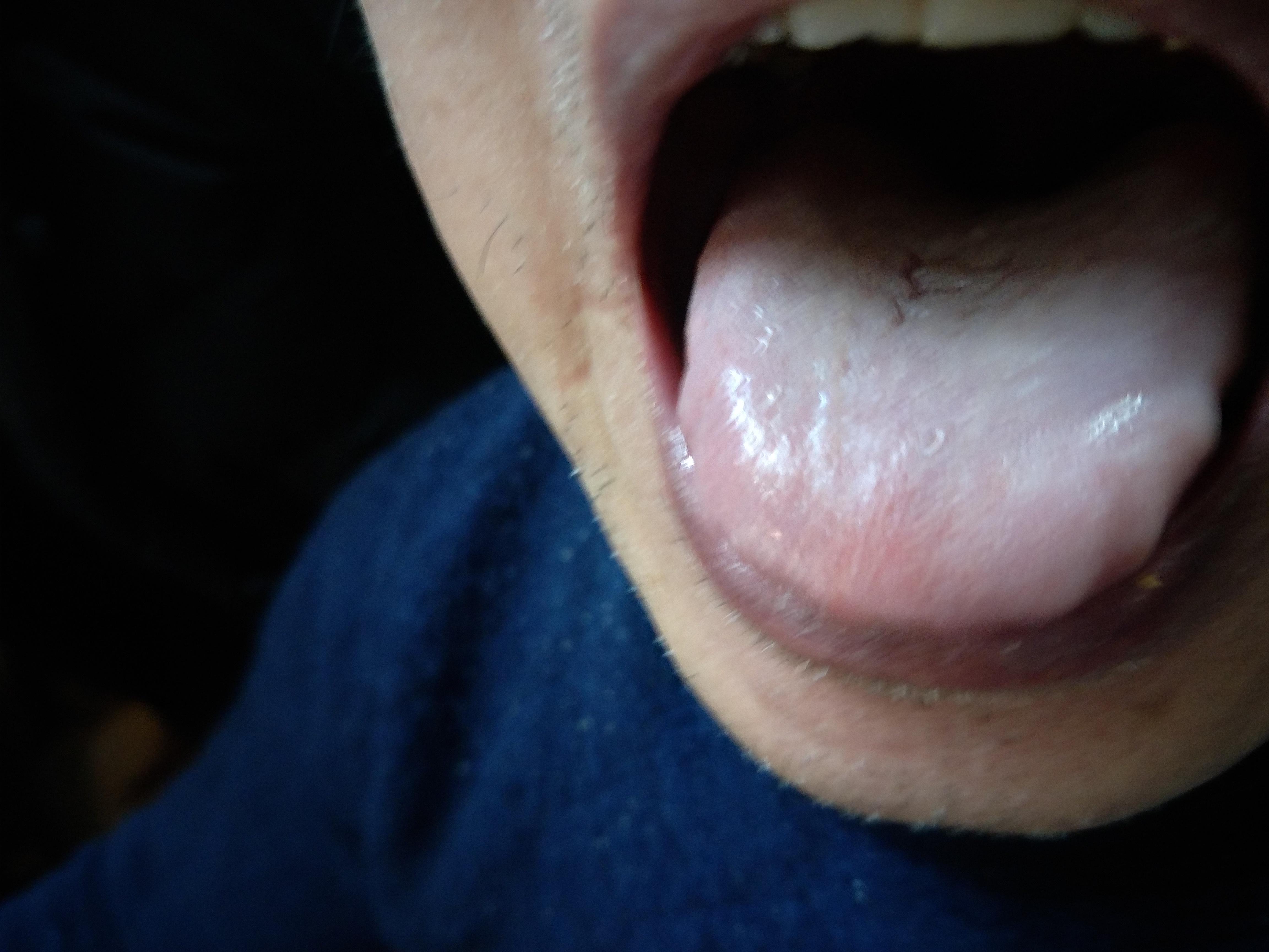 男，64岁，头晕，半身不遂10年余 舌面.jpg