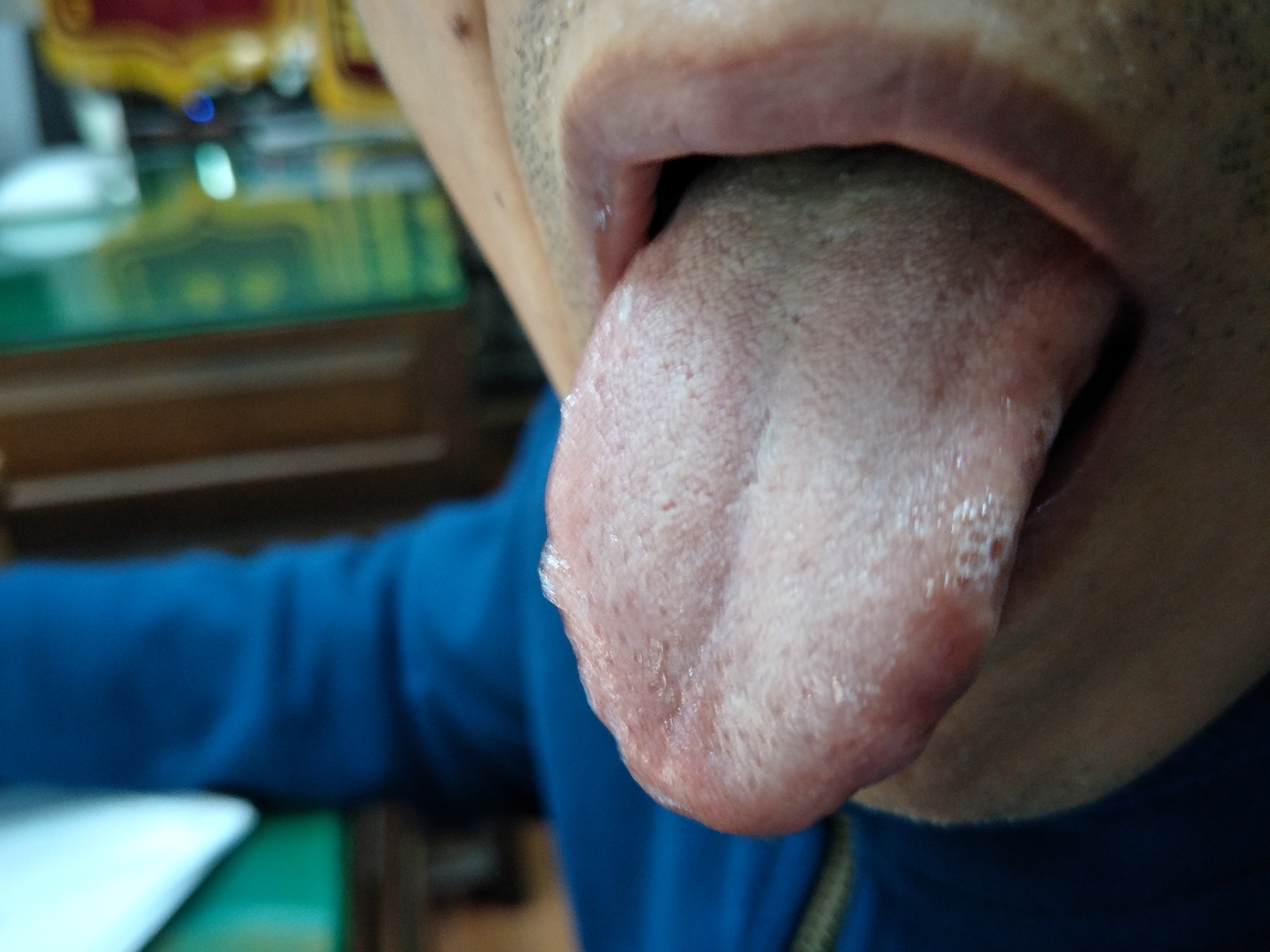 男，65岁，心悸6月 舌面.jpg