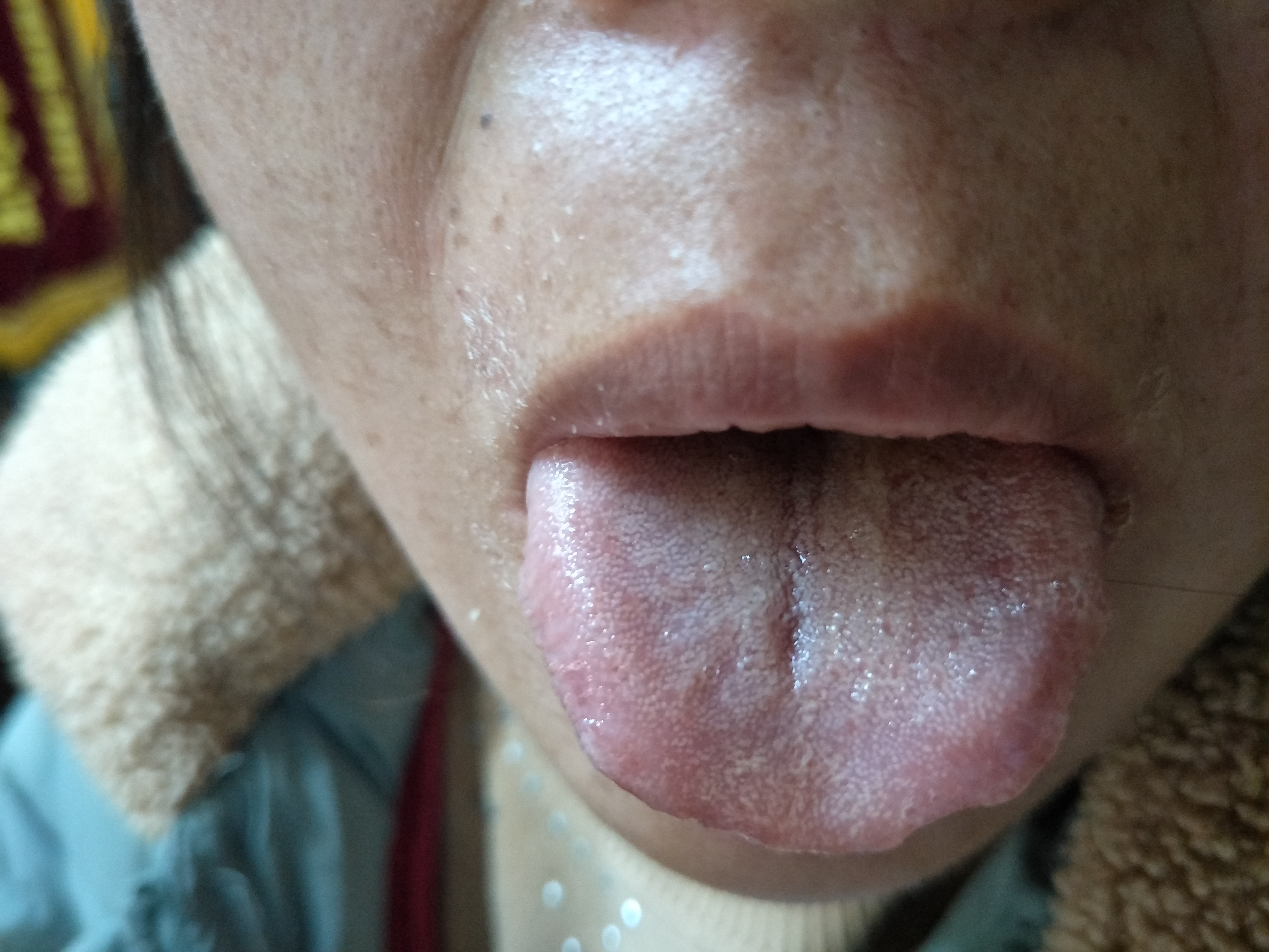 女，41岁，气短乏力半年余 舌面.jpg