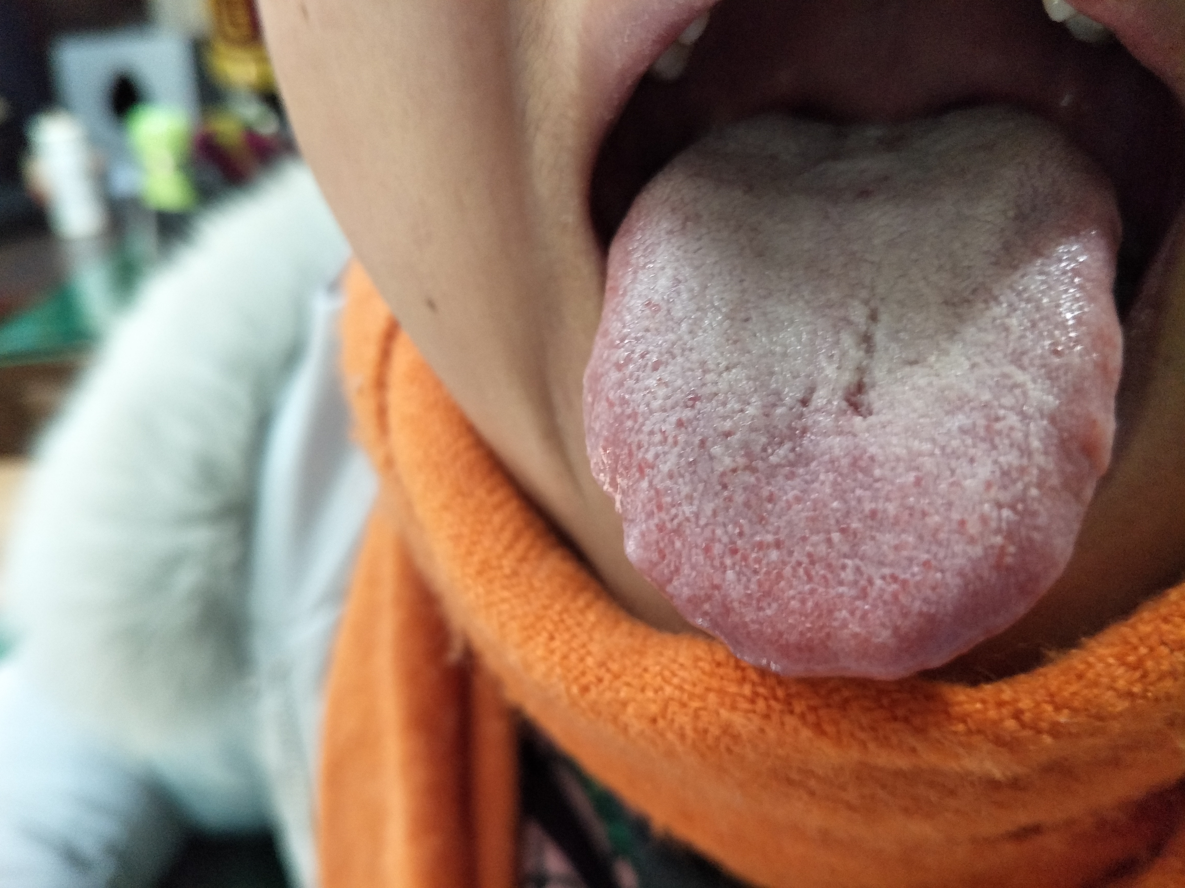 女，43，嗳气，泛酸10余年 舌面.jpg