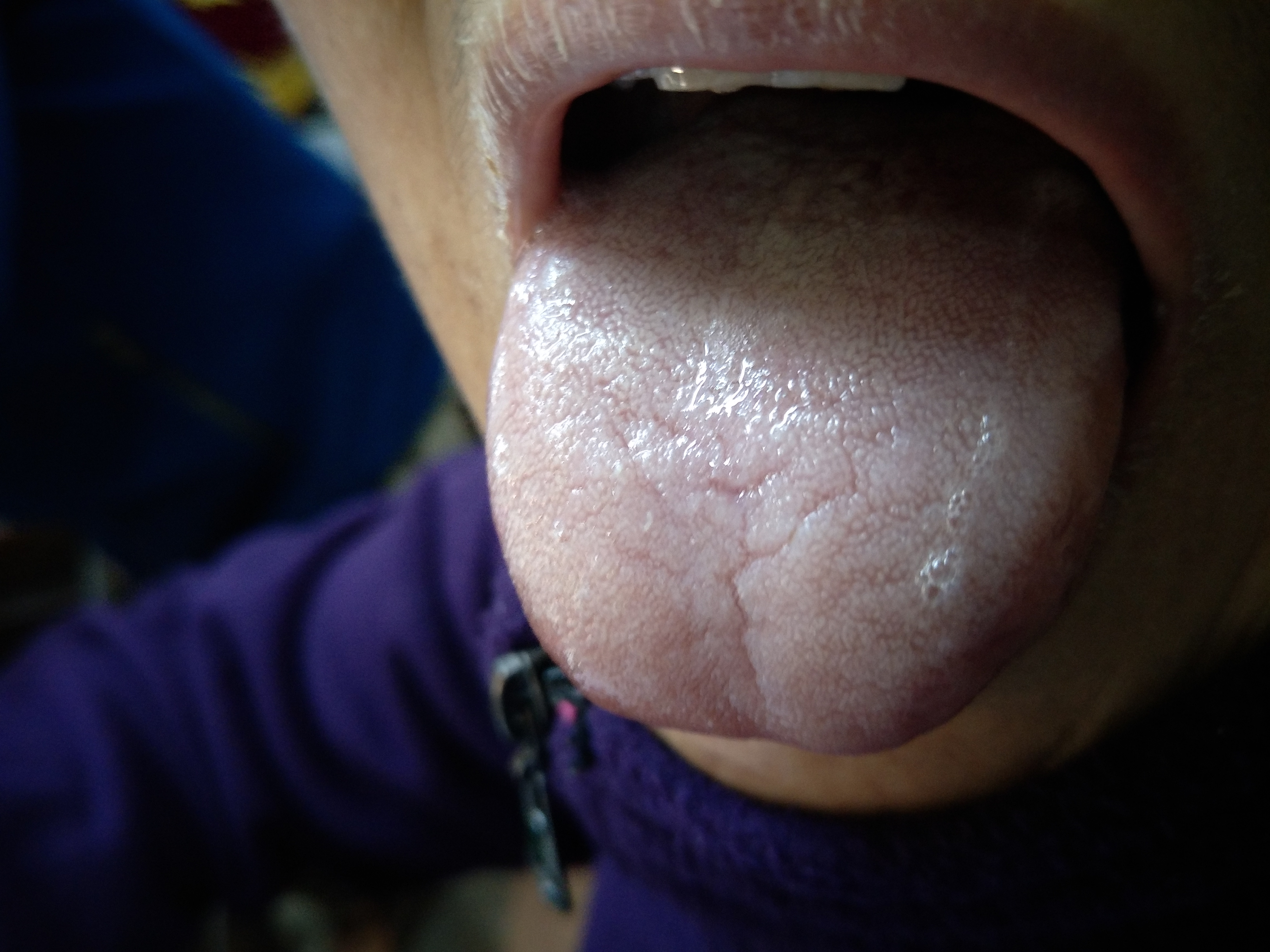 女，61岁，间断胃痛5年  舌面.jpg