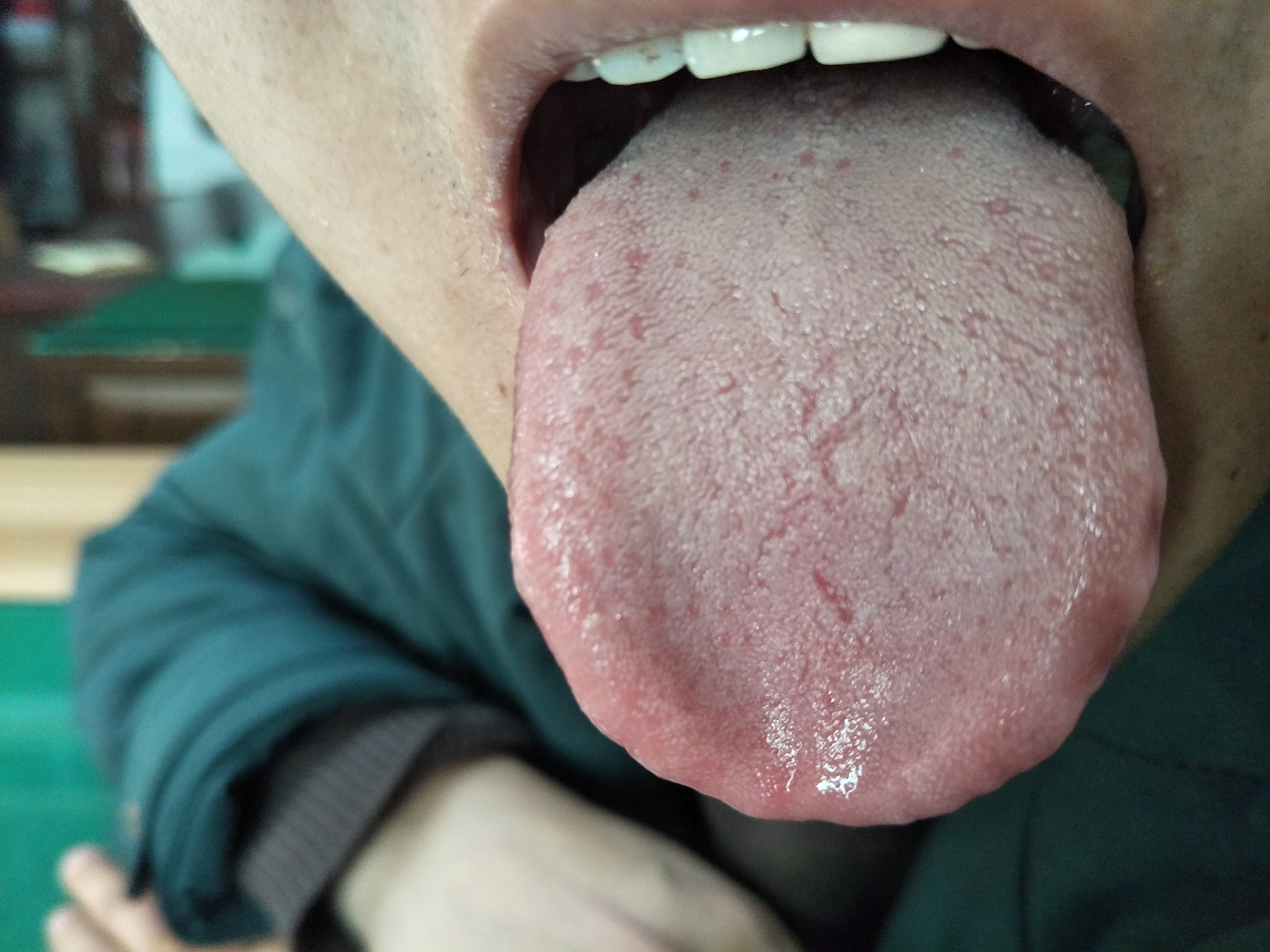 男，29岁，乏力，性功能低下1年  舌面.jpg