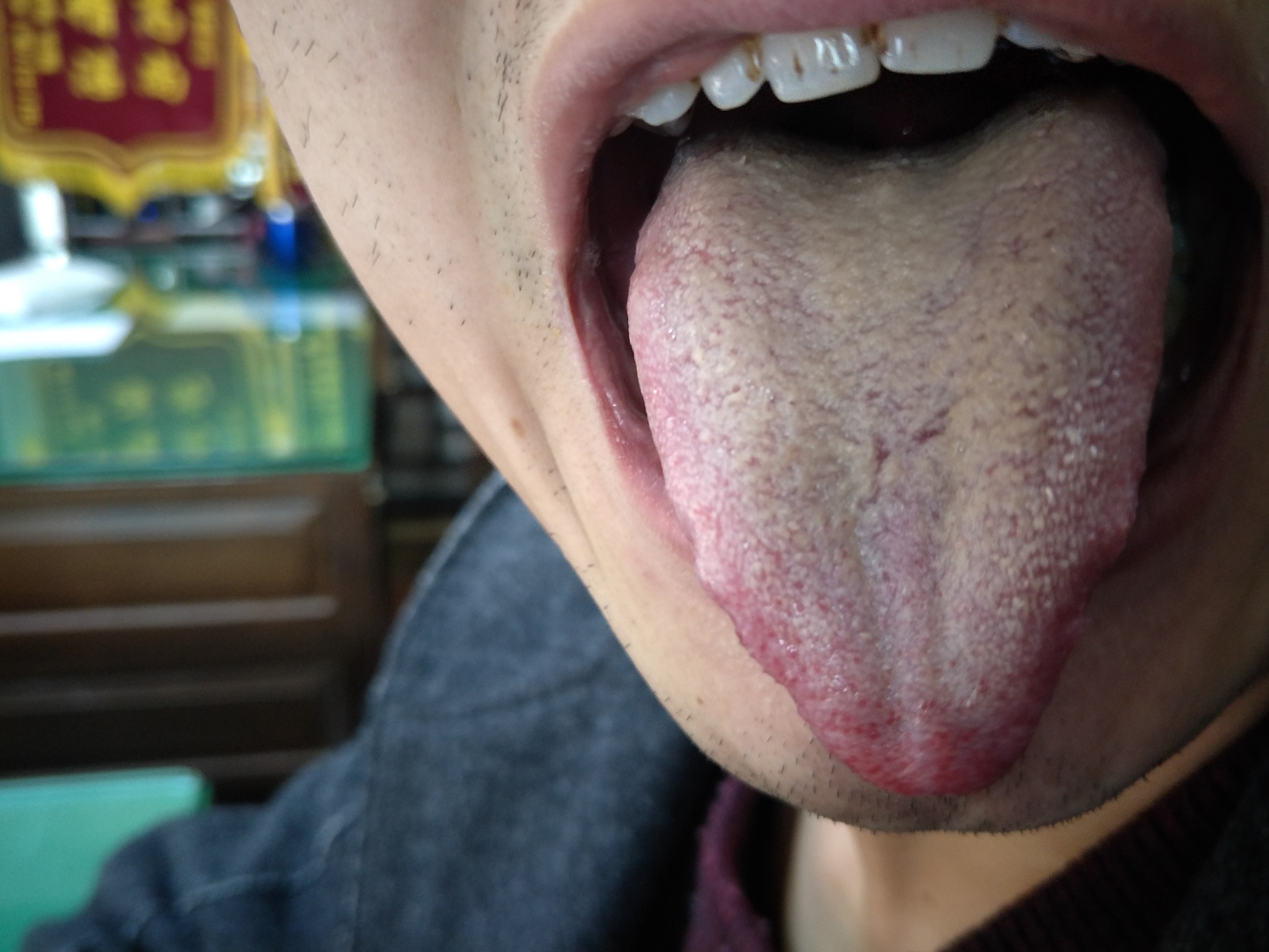 男，33岁，乏力1年余 舌面.jpg