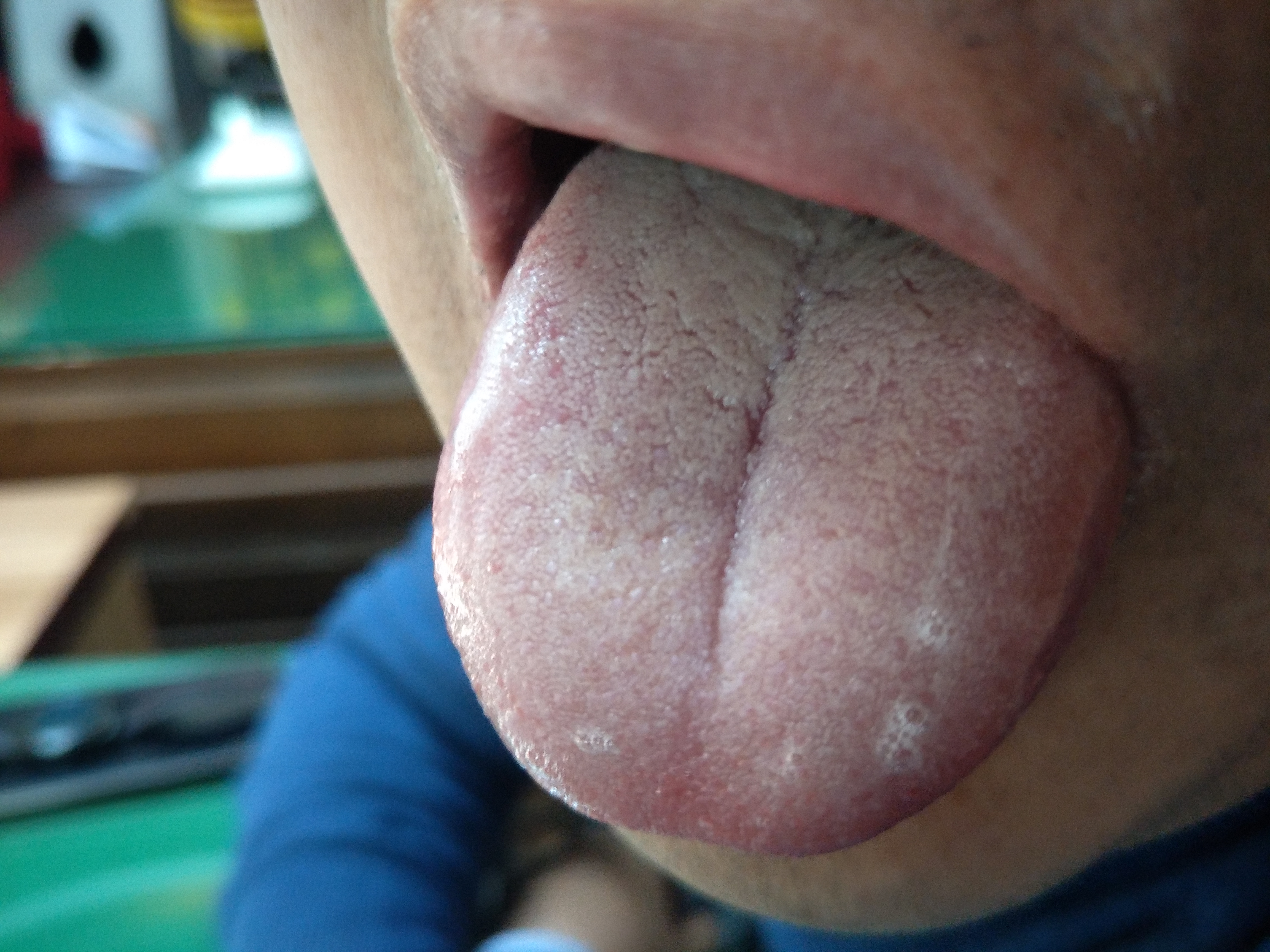 男，36岁，肠胃不适1年余 舌面.jpg