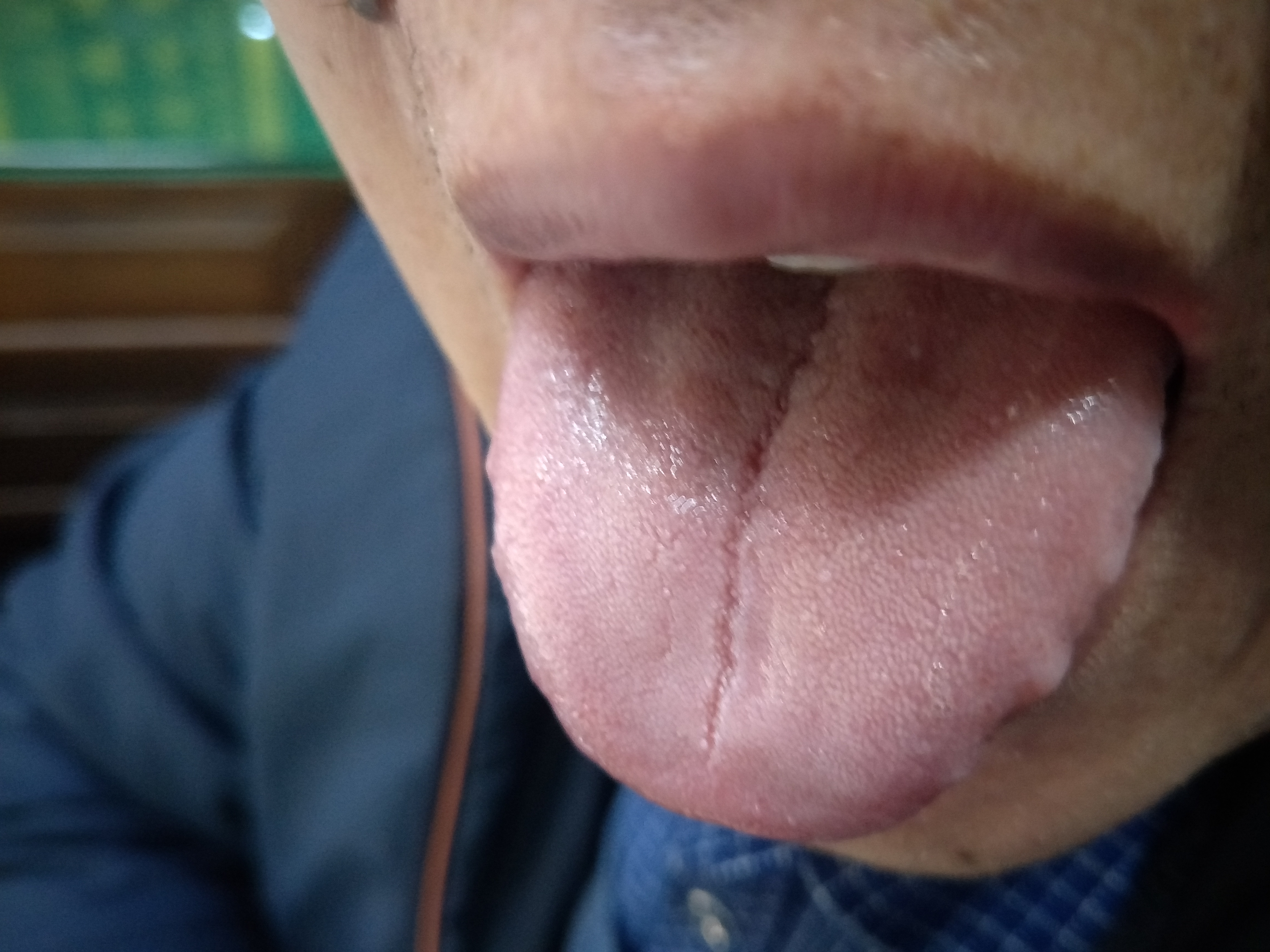 男，39岁，发现感染乙肝病毒13年余 舌面.jpg