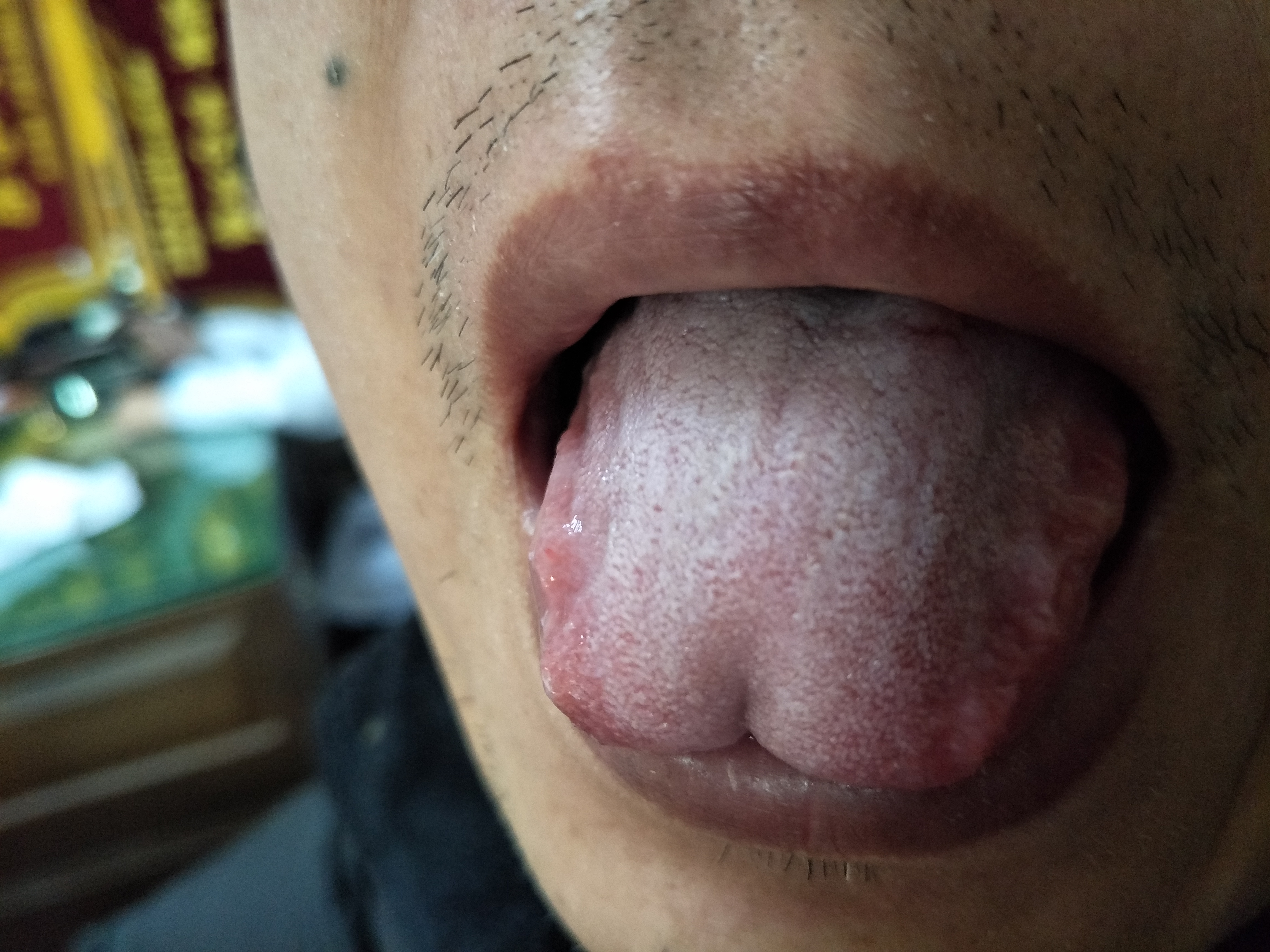 男，49岁，全身肌肉酸胀疼痛6年余 舌面.jpg