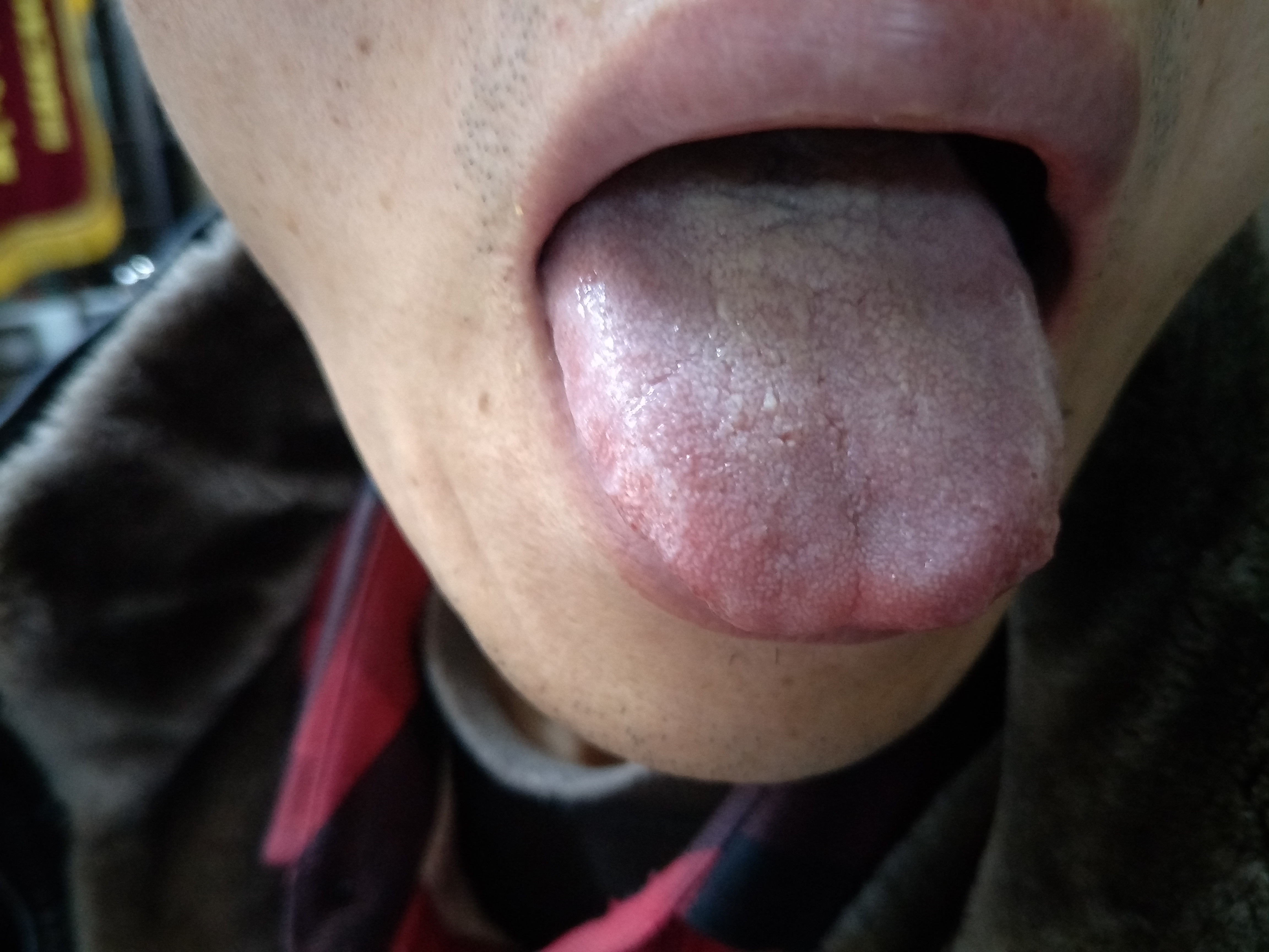 男，53岁，左大腿平滑肌瘤半月余 舌面.jpg