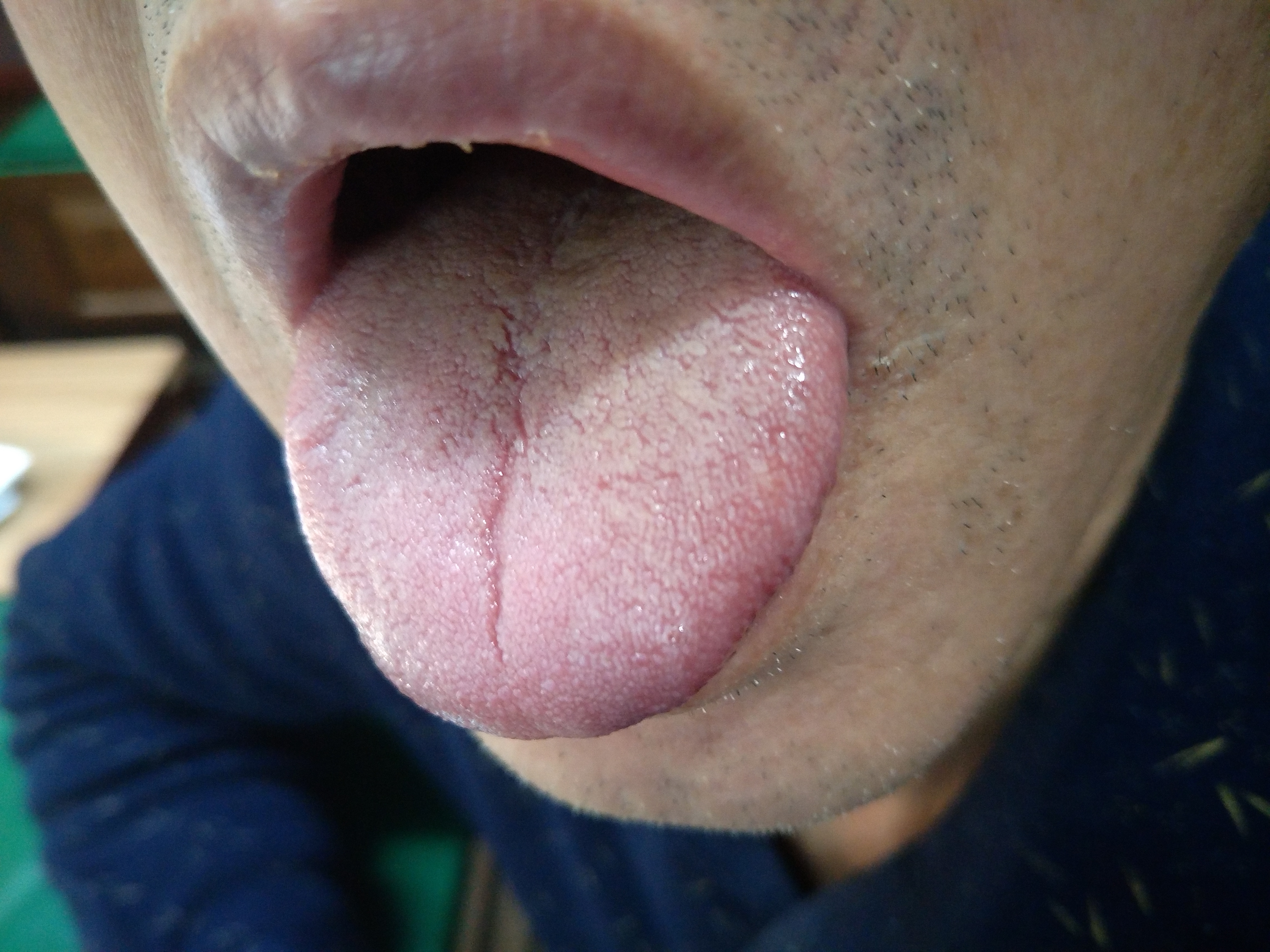 男，55岁，食管癌术后1年余 舌面.jpg