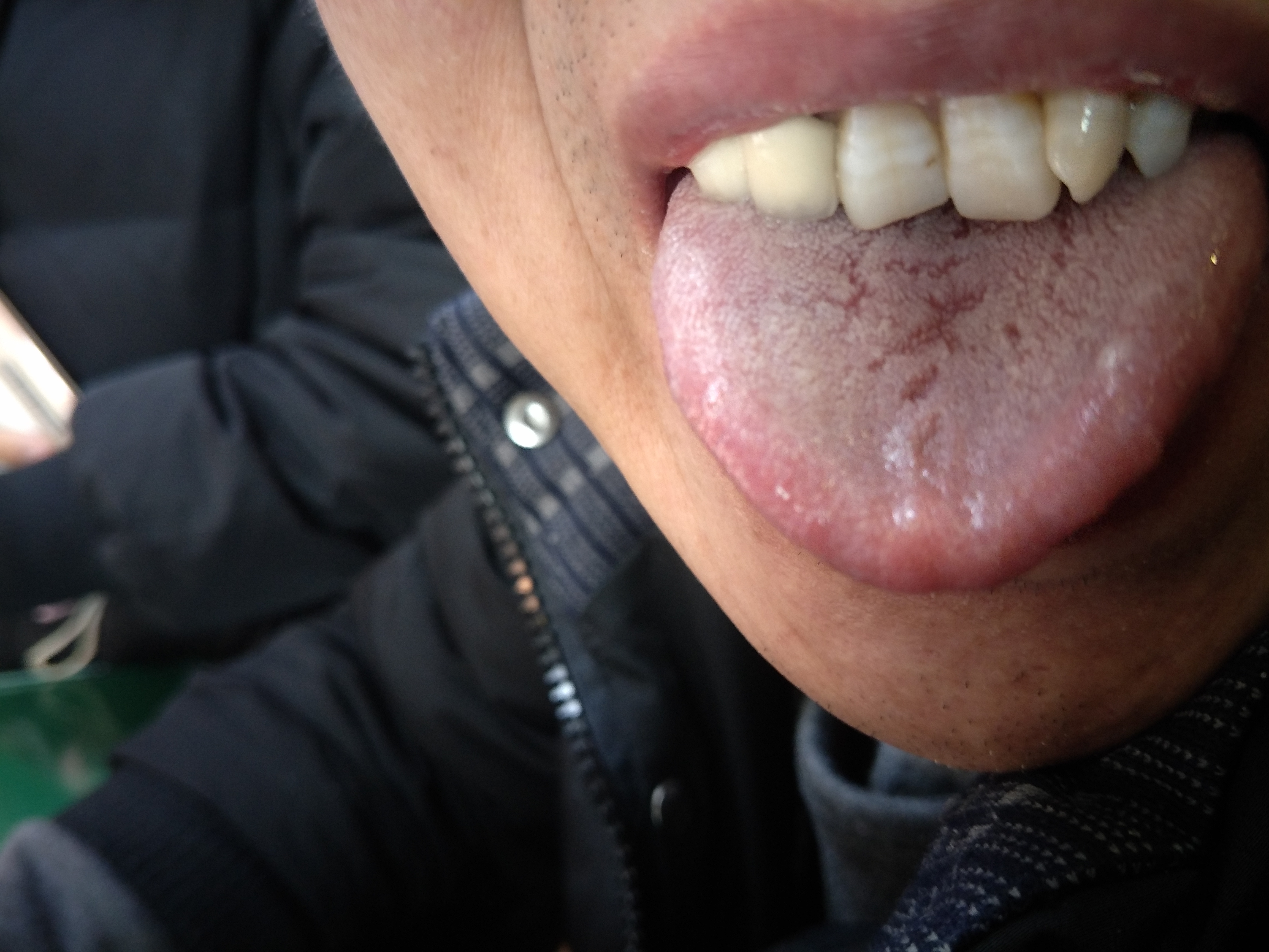 男，55岁，直肠癌术后2月 舌面.jpg