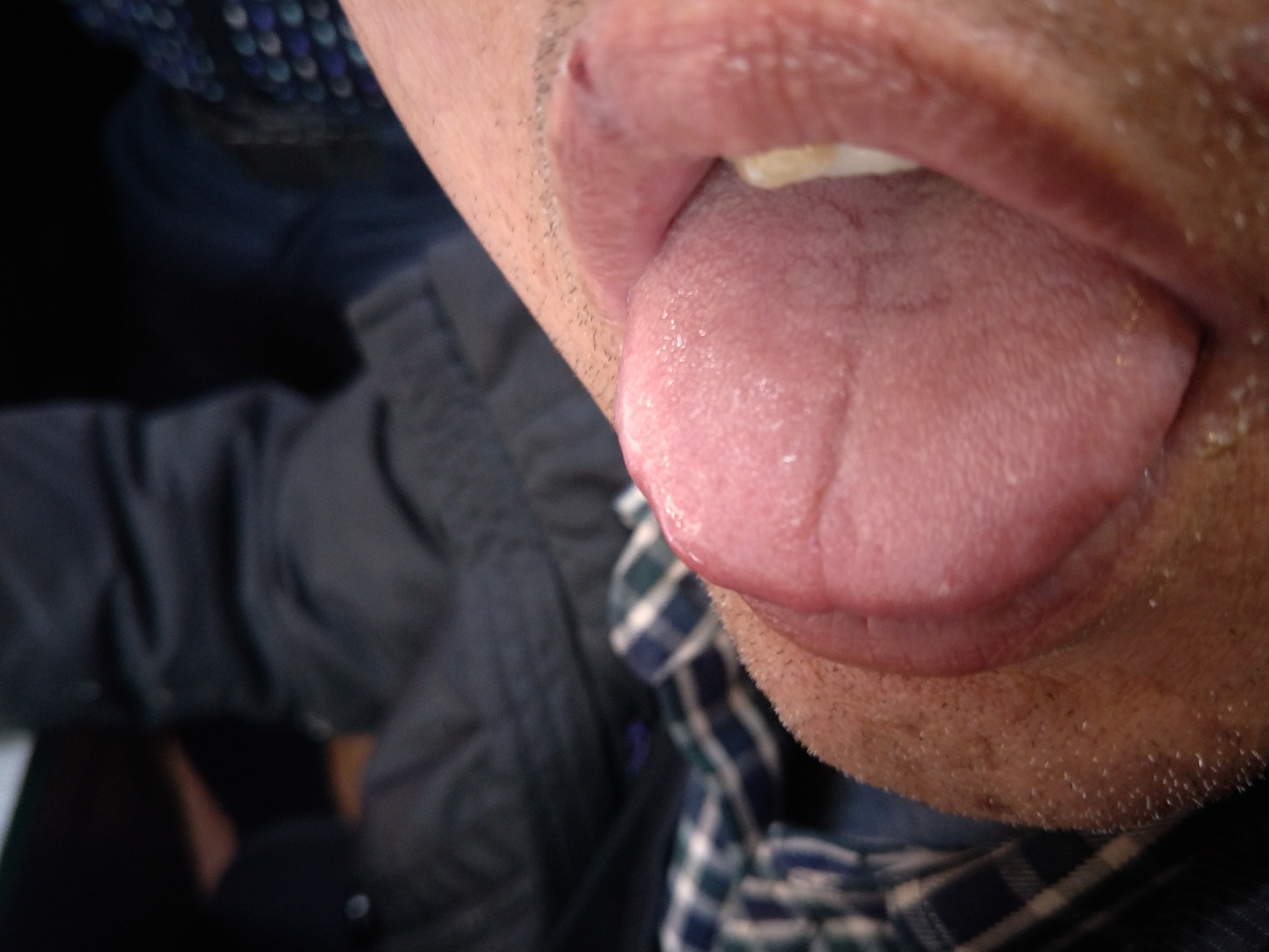 男，56岁，左甲状腺癌术后6年余 舌面.jpg