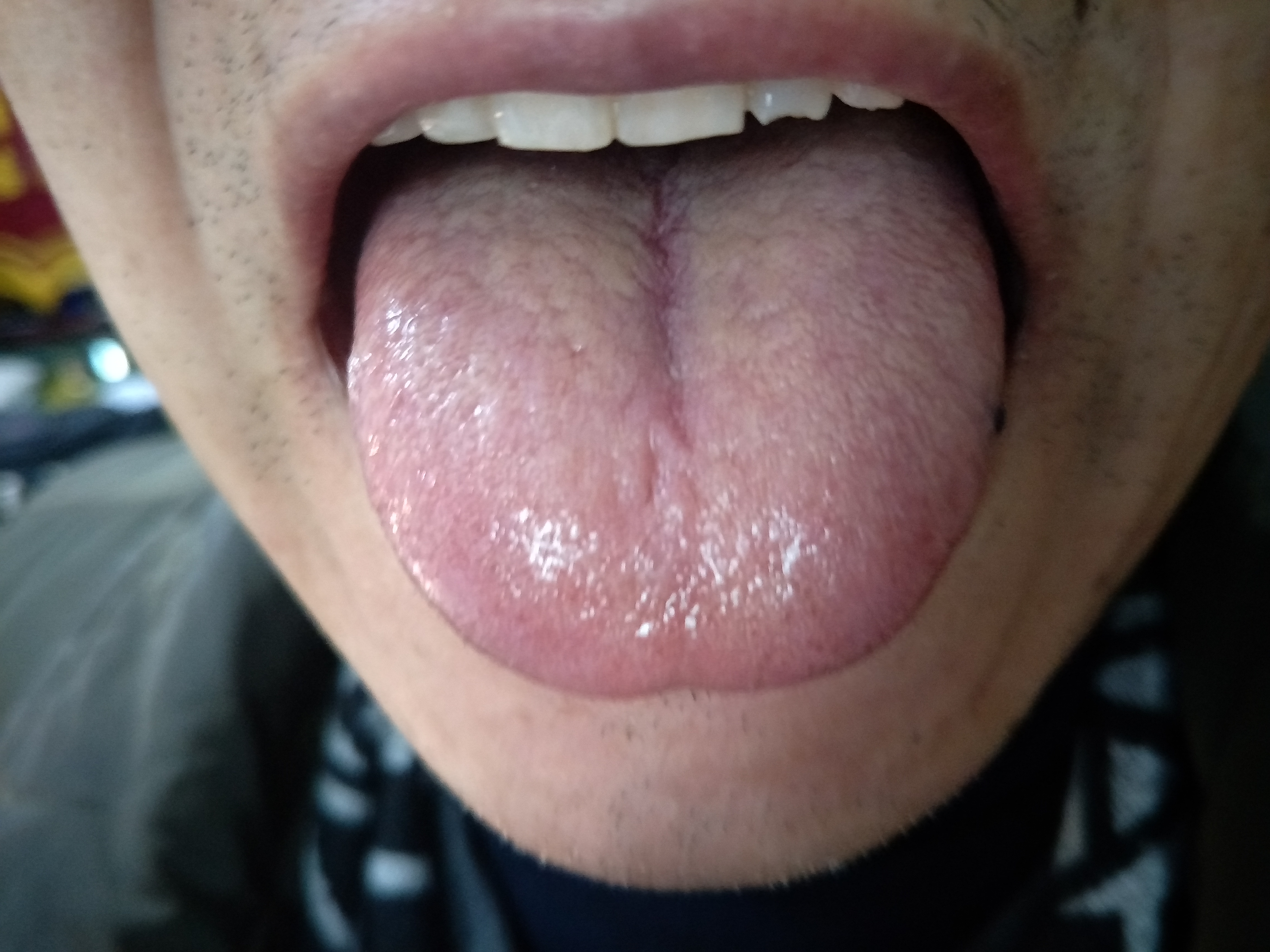 男，63岁，头晕，耳鸣1年  舌面.jpg