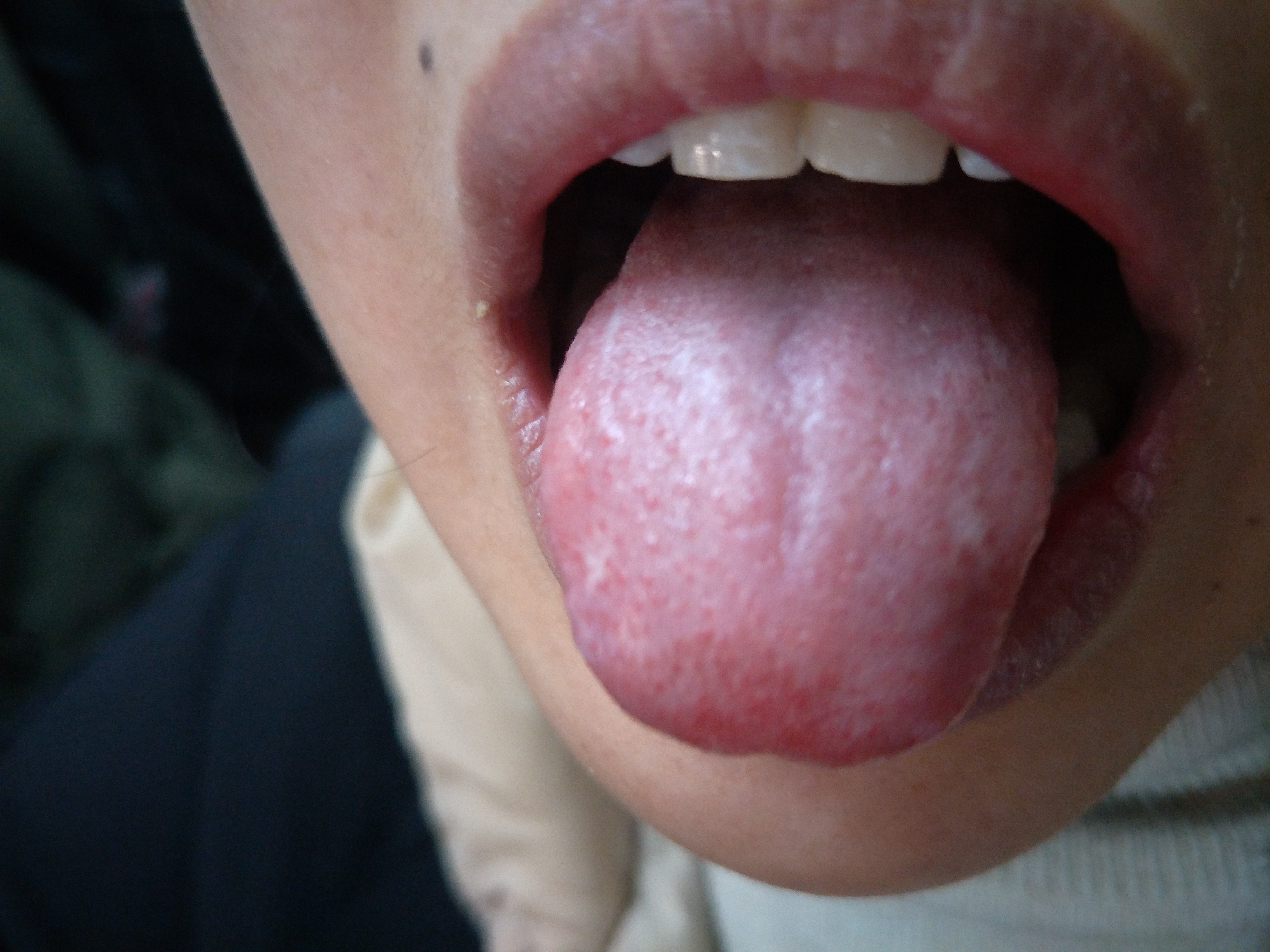 女，28岁，四肢乏力萎缩3年余 舌面.jpg