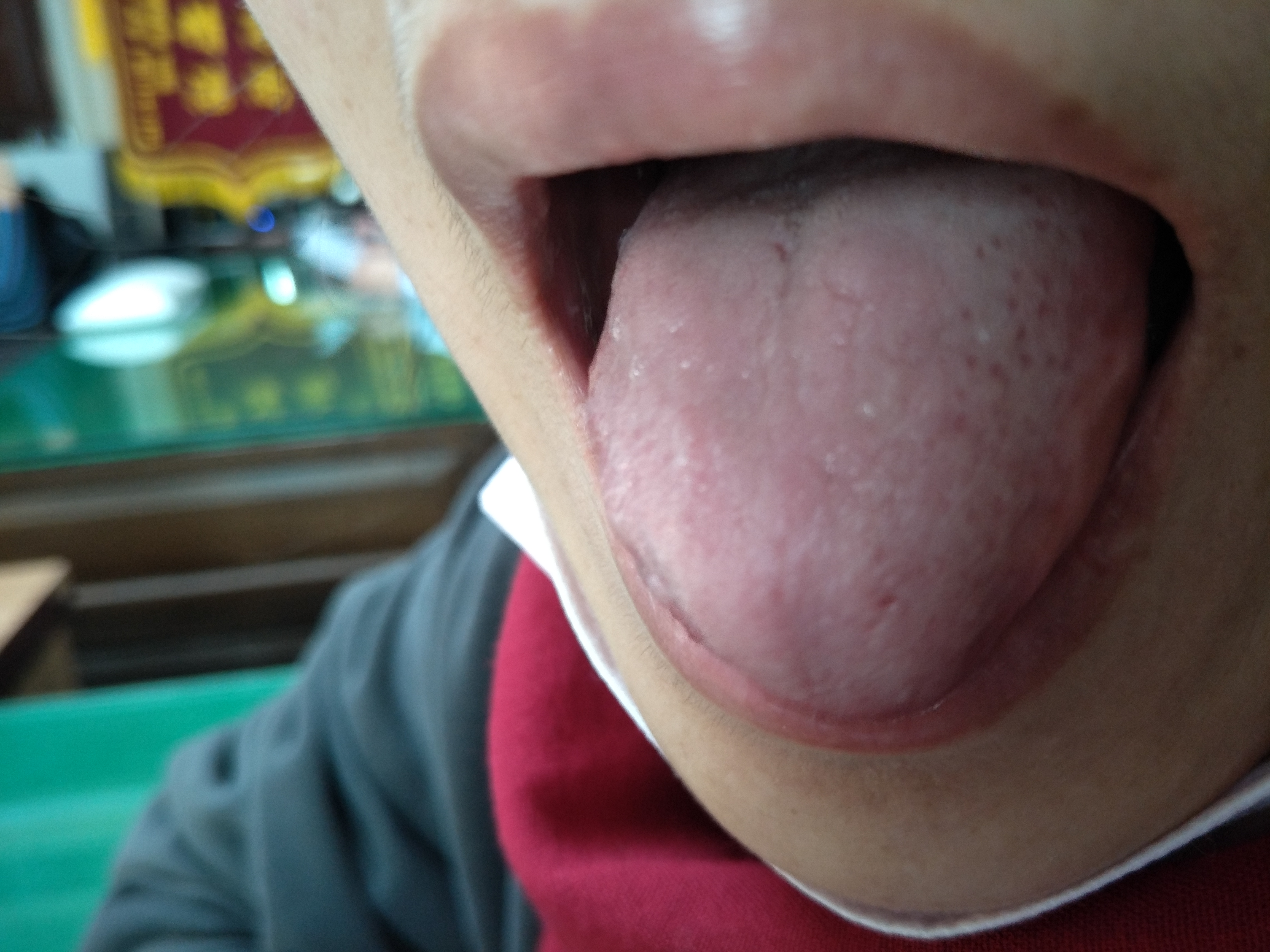 女，30岁经期延长淋漓不尽7月余 舌面.jpg