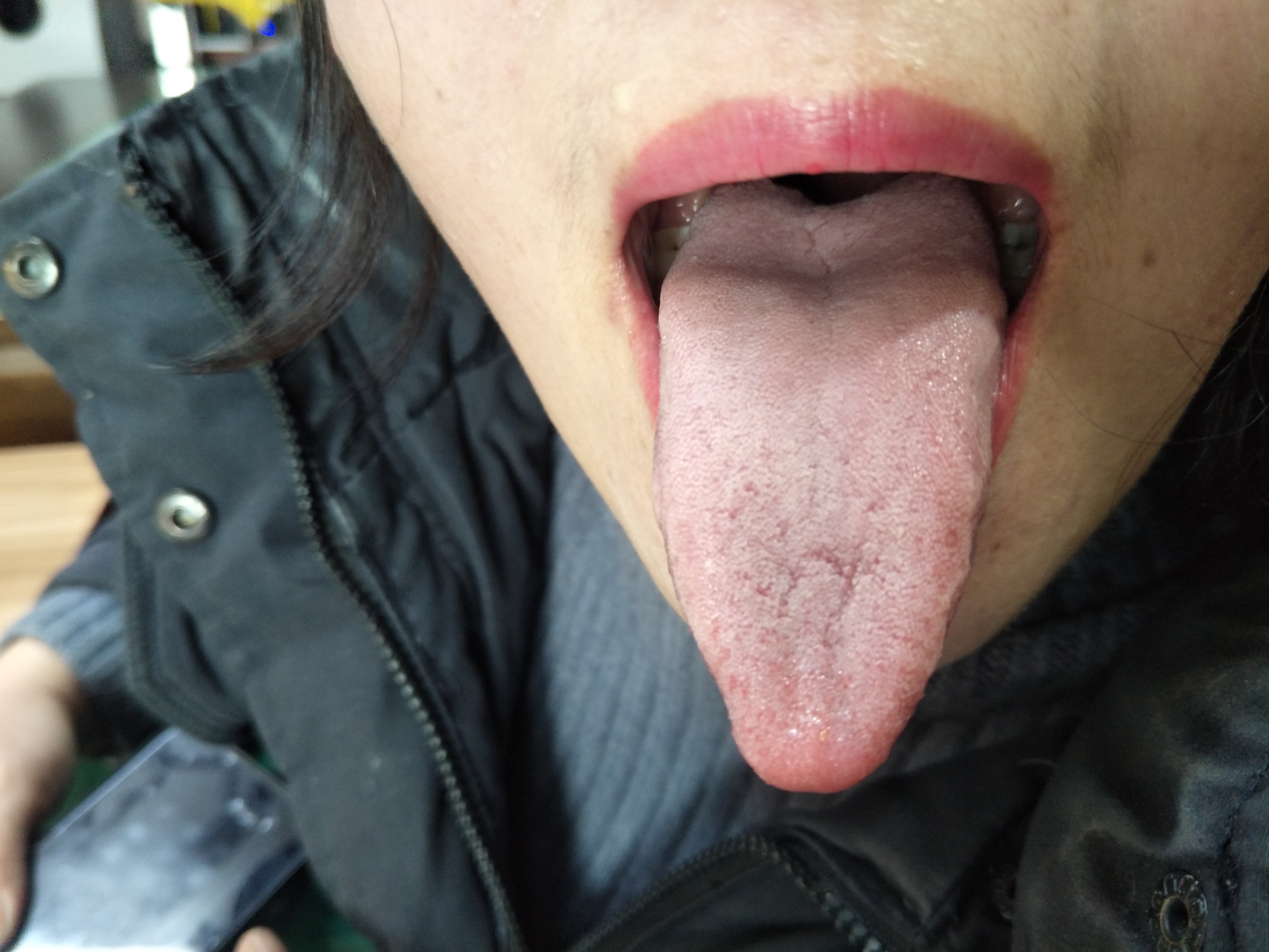 女，50岁，咳嗽反复10余年  舌面.jpg