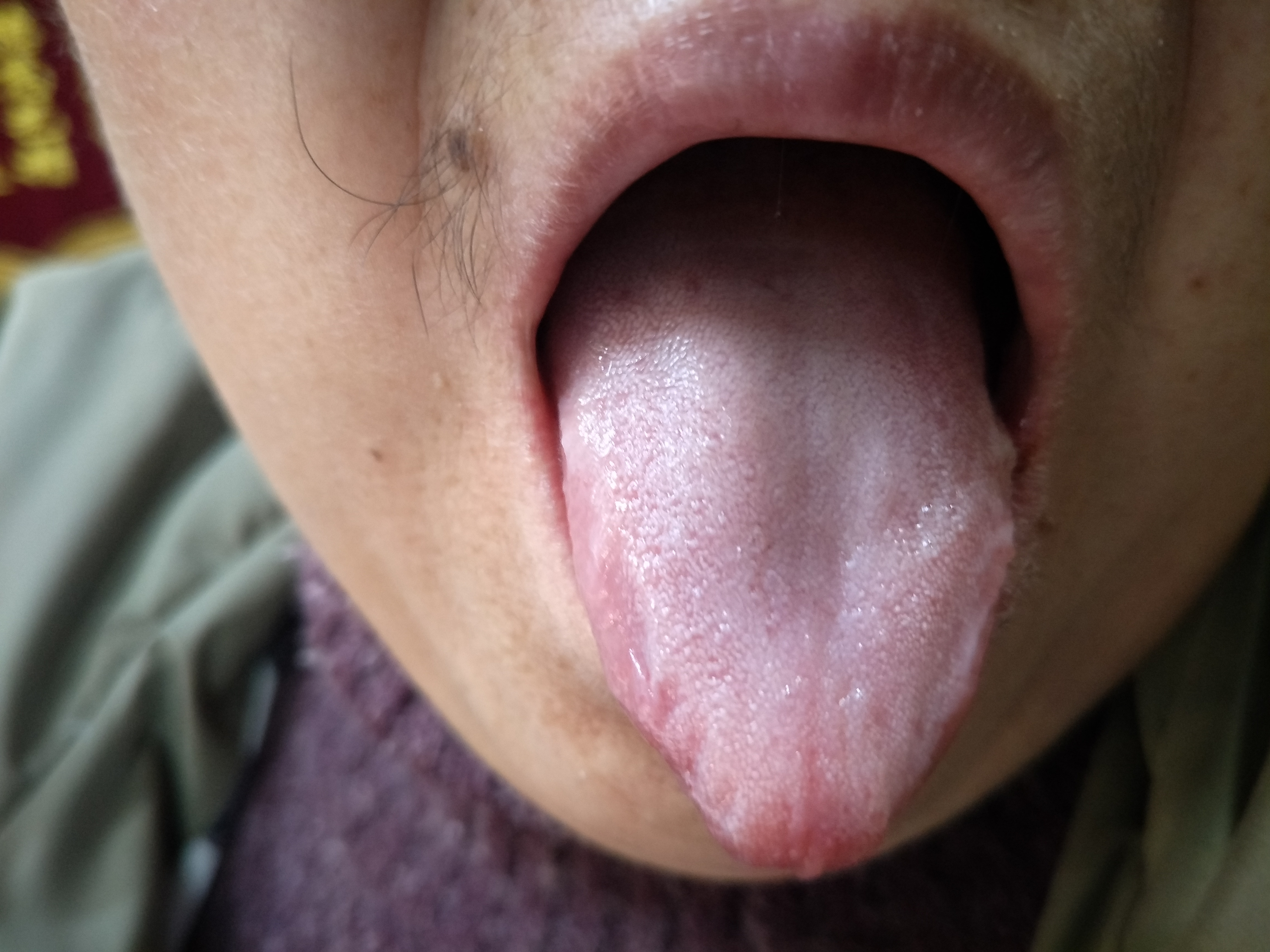 女，55岁，双膝疼痛1年 舌面.jpg