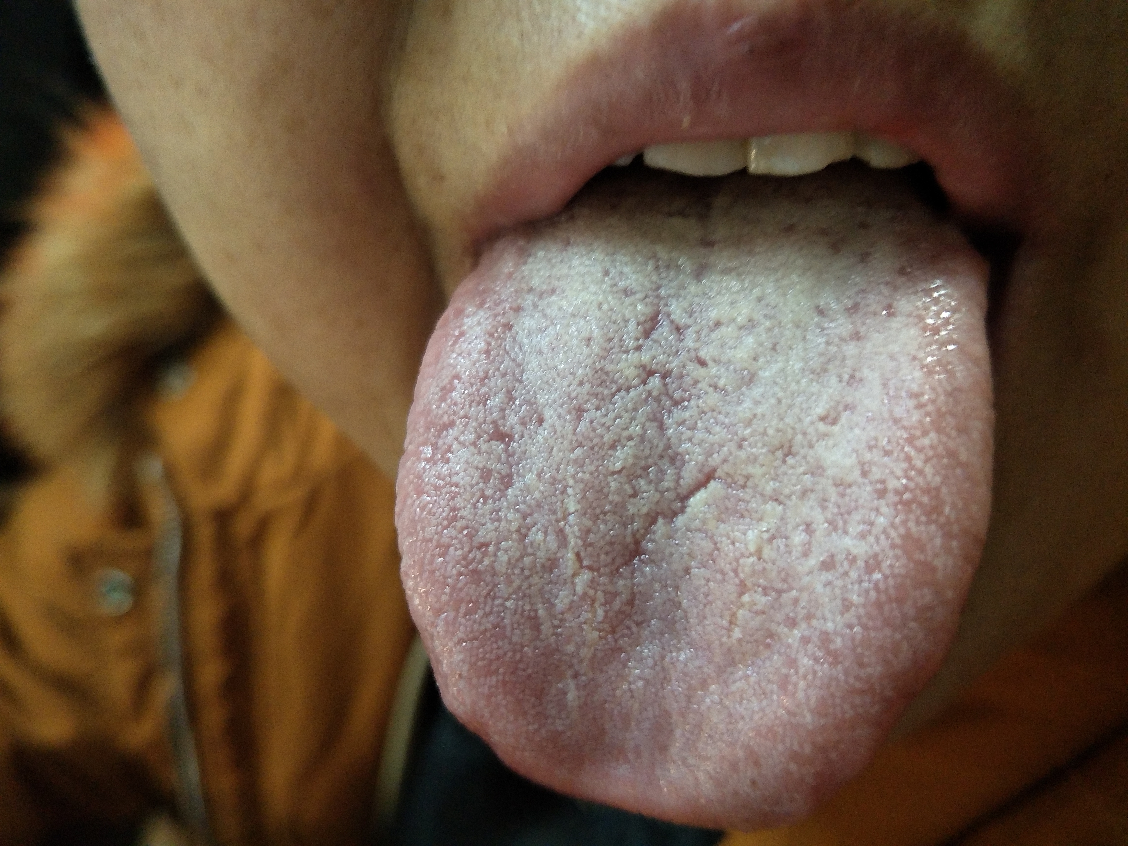 女，55岁，胸闷，心慌1年余  舌面.jpg