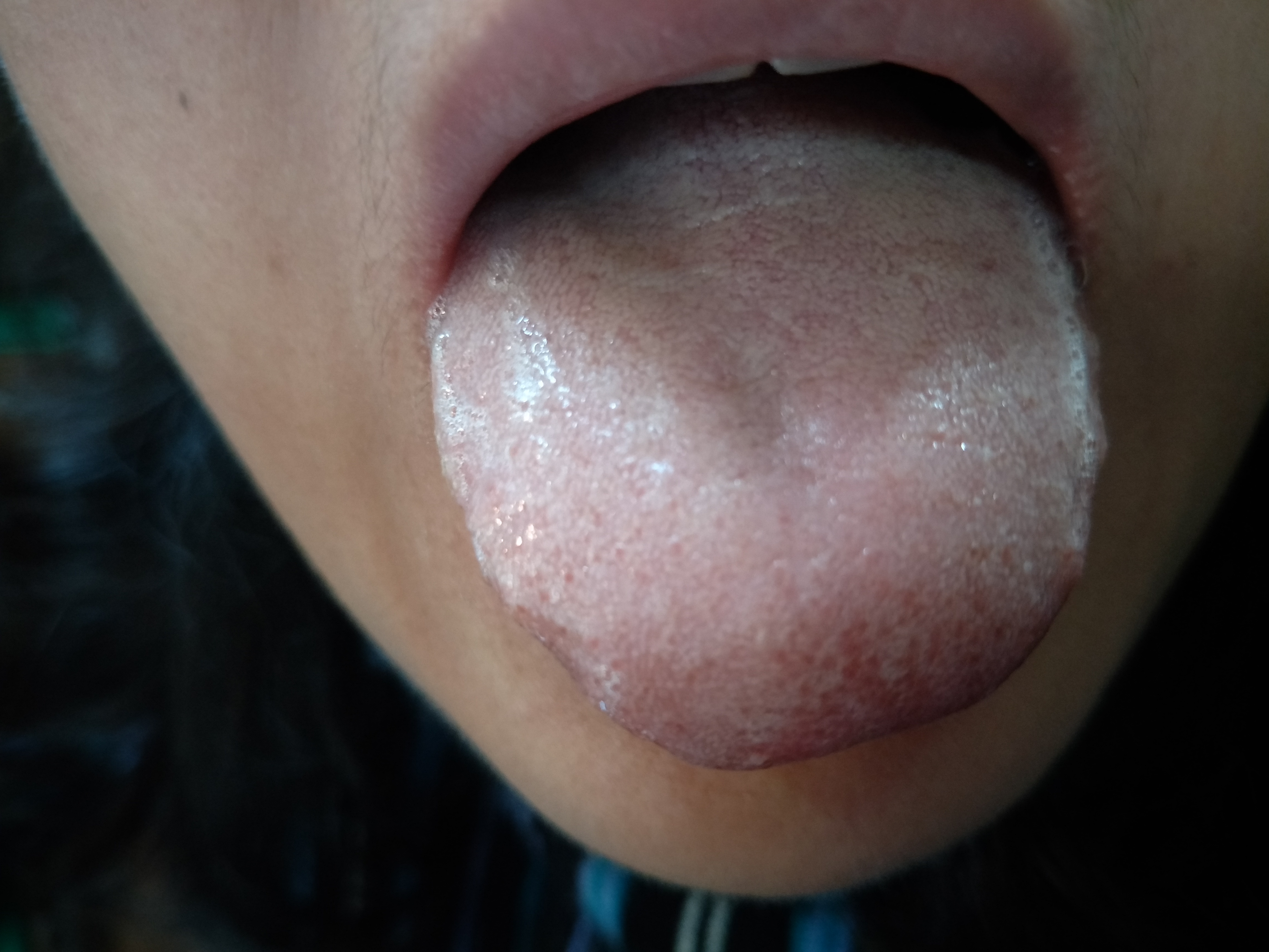 女，56岁，小汗腺瘤30余年 舌面.jpg